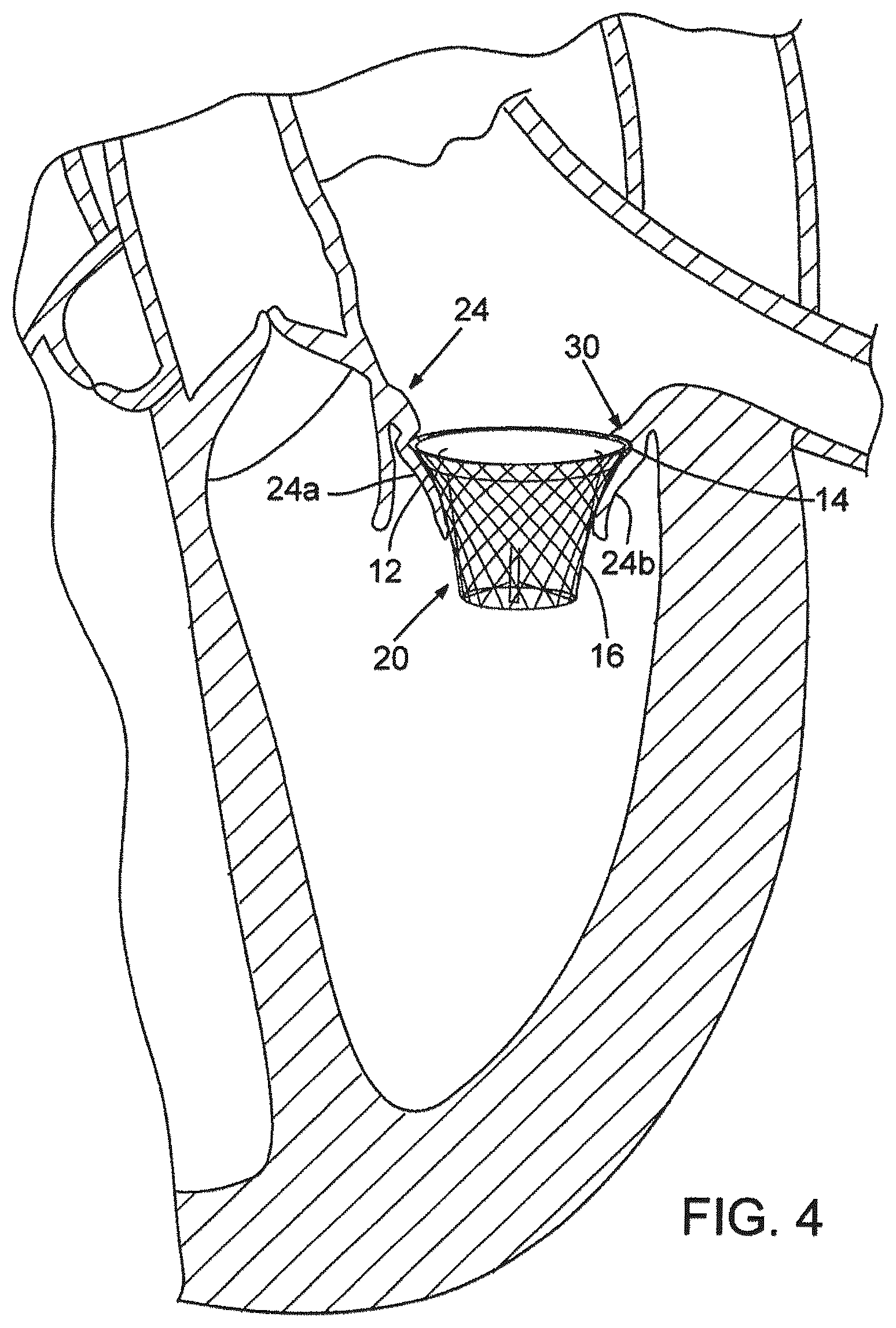 Patent US12376961 Figure 5 – Method of implanting a prosthetic heart valve assembly