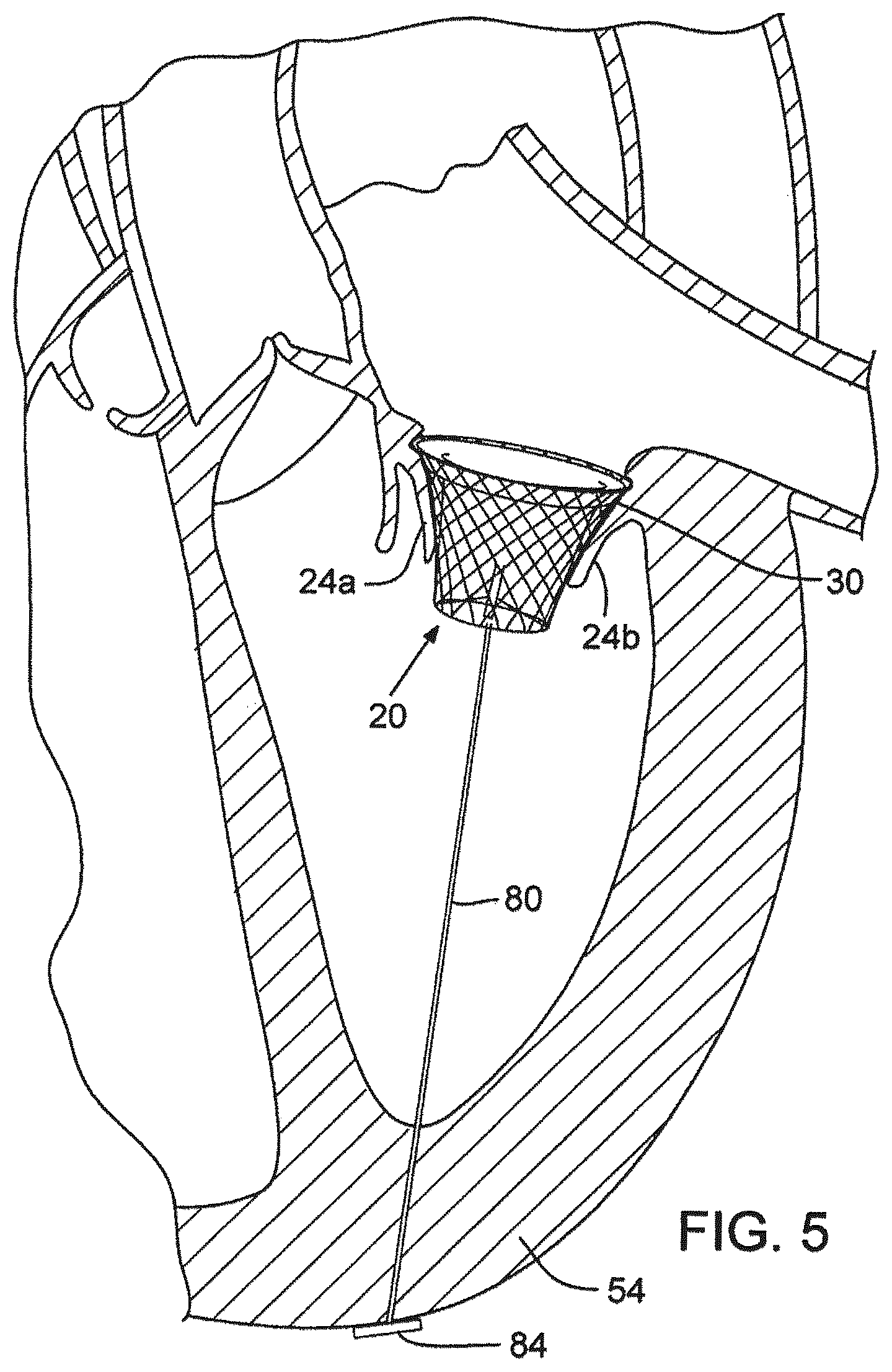 Patent US12376961 Figure 6 – Method of implanting a prosthetic heart valve assembly