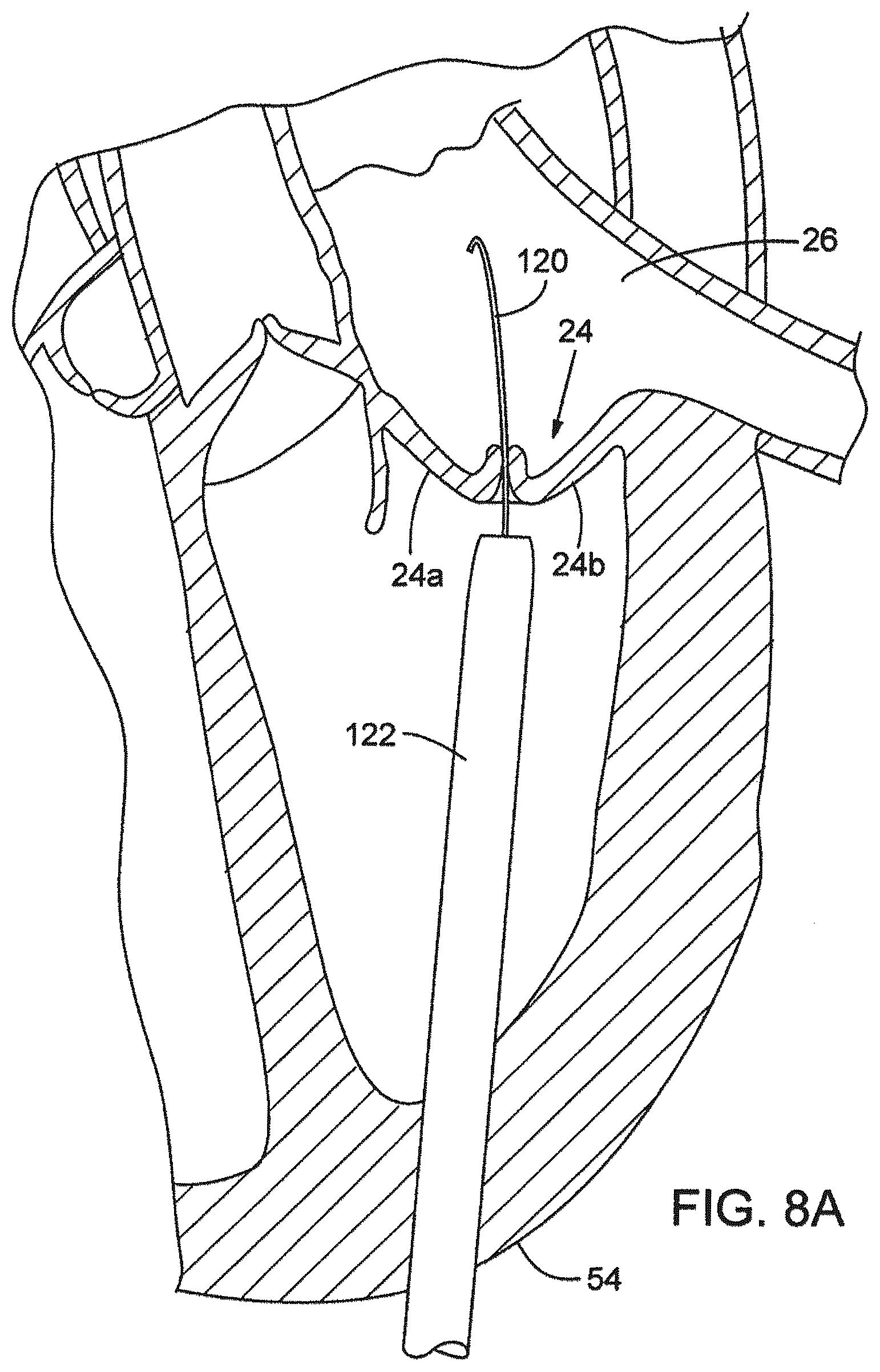 Patent US12376961 Figure 8 – Method of implanting a prosthetic heart valve assembly
