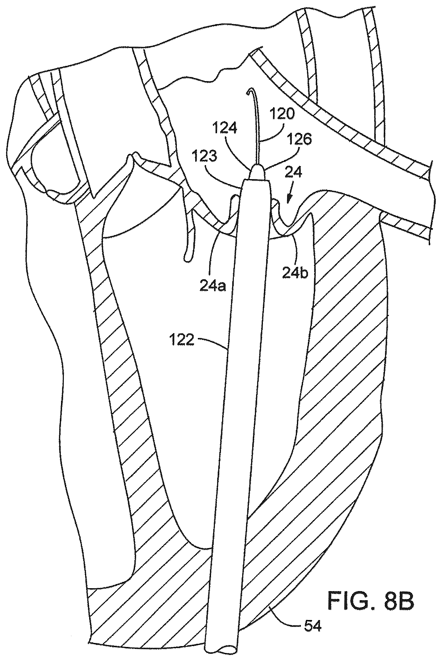 Patent US12376961 Figure 9 – Method of implanting a prosthetic heart valve assembly