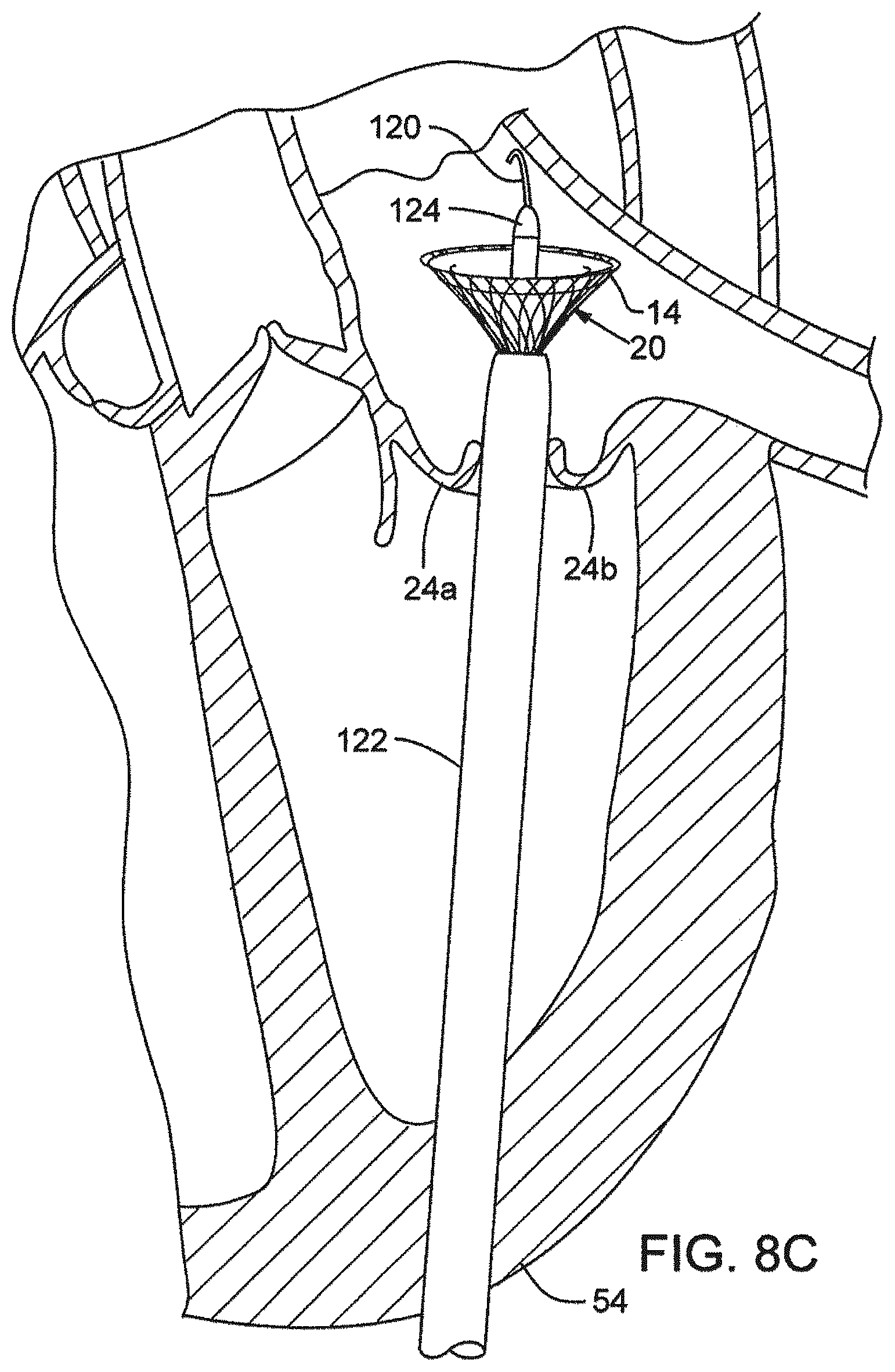 Patent US12376961 Figure 10 – Method of implanting a prosthetic heart valve assembly