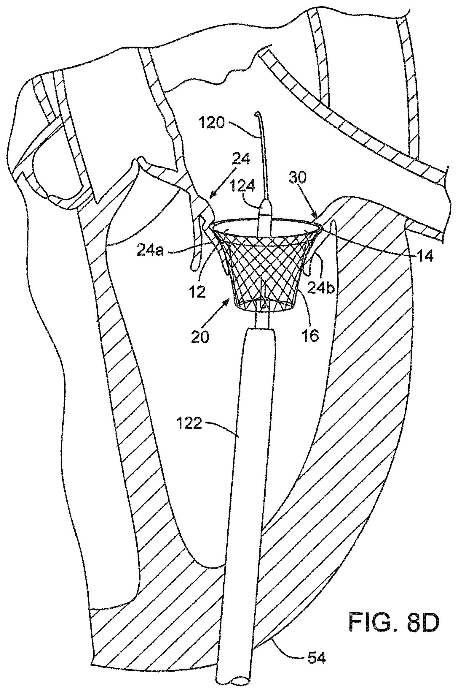 Patent US12376961 Figure 11 – Method of implanting a prosthetic heart valve assembly