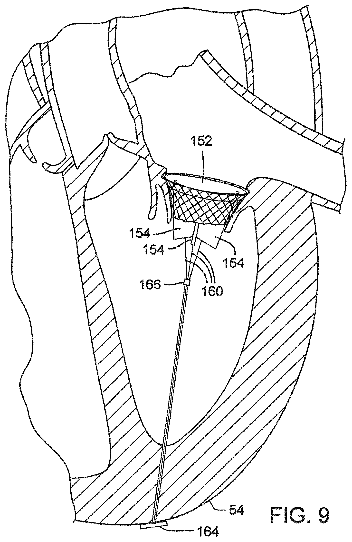 Patent US12376961 Figure 12 – Method of implanting a prosthetic heart valve assembly