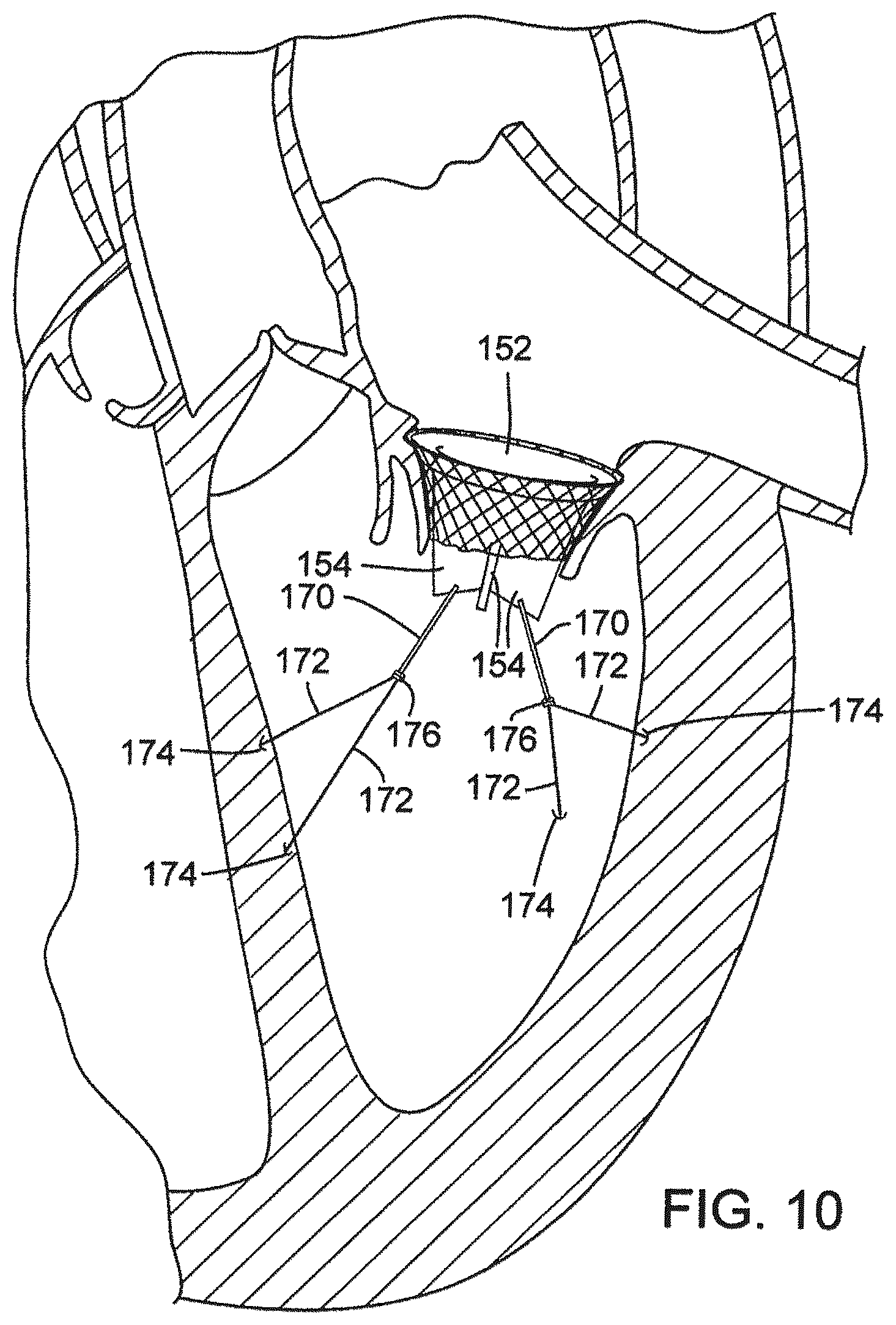 Patent US12376961 Figure 13 – Method of implanting a prosthetic heart valve assembly