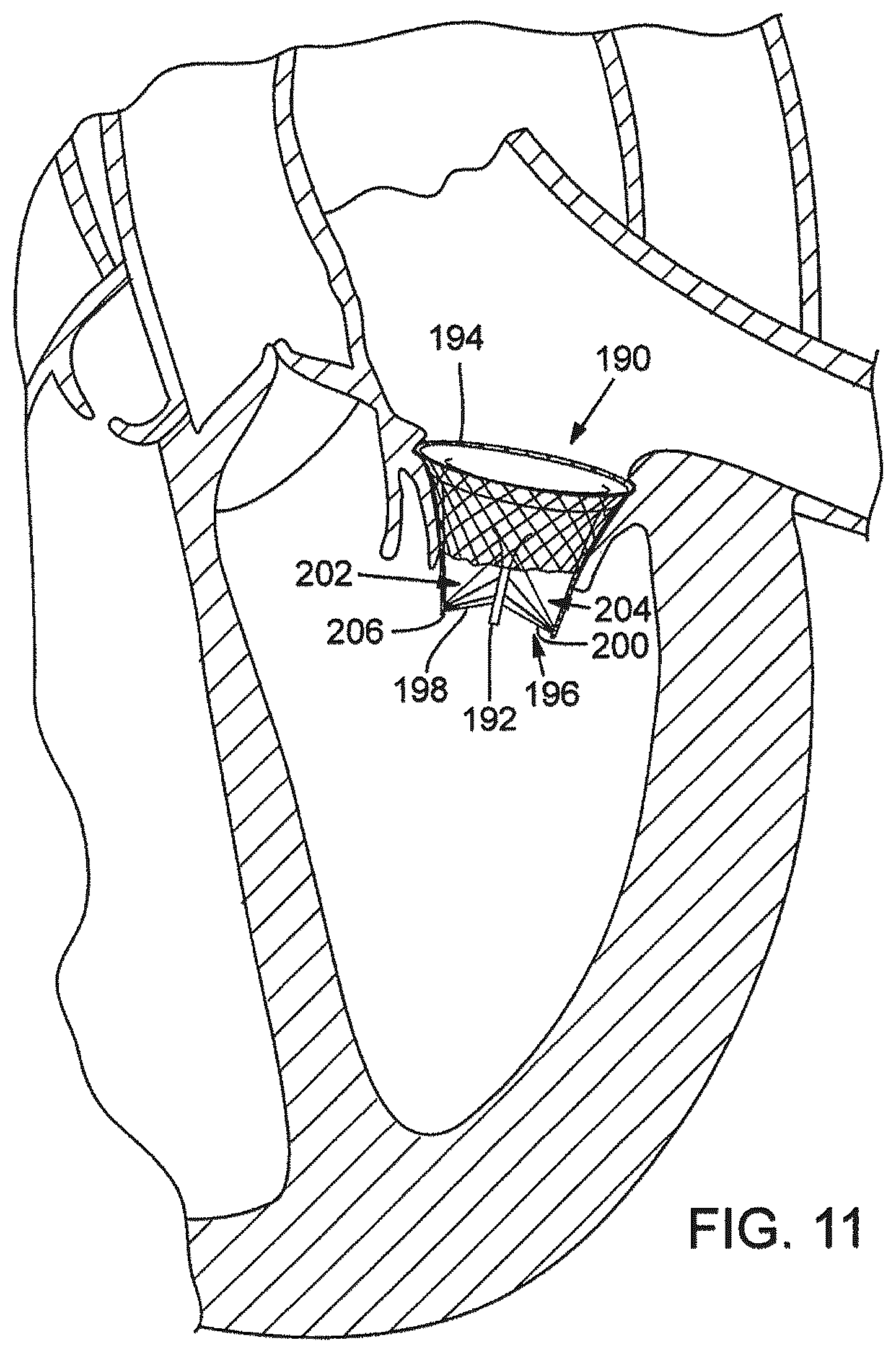 Patent US12376961 Figure 14 – Method of implanting a prosthetic heart valve assembly