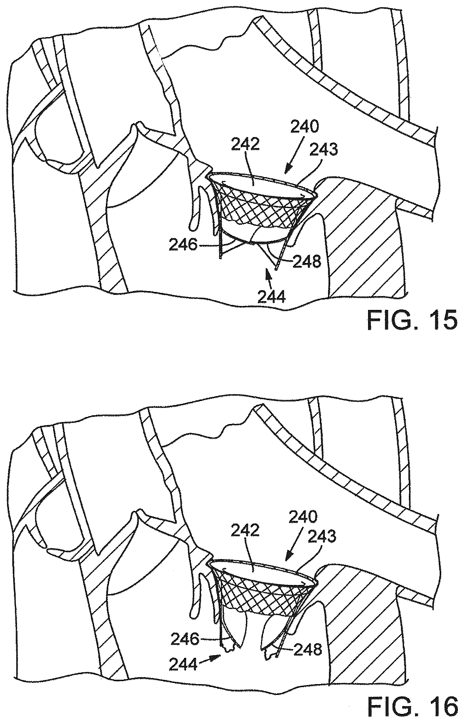 Patent US12376961 Figure 16 – Method of implanting a prosthetic heart valve assembly