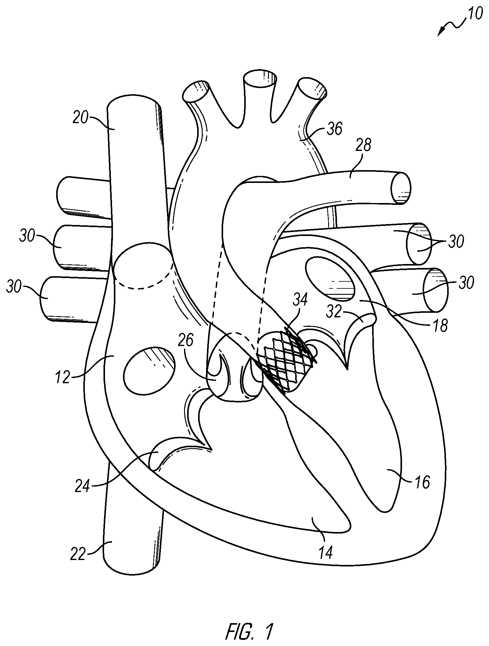 Patent US12376962 Figure 1 – Methods and devices for delivery of a prosthetic valve