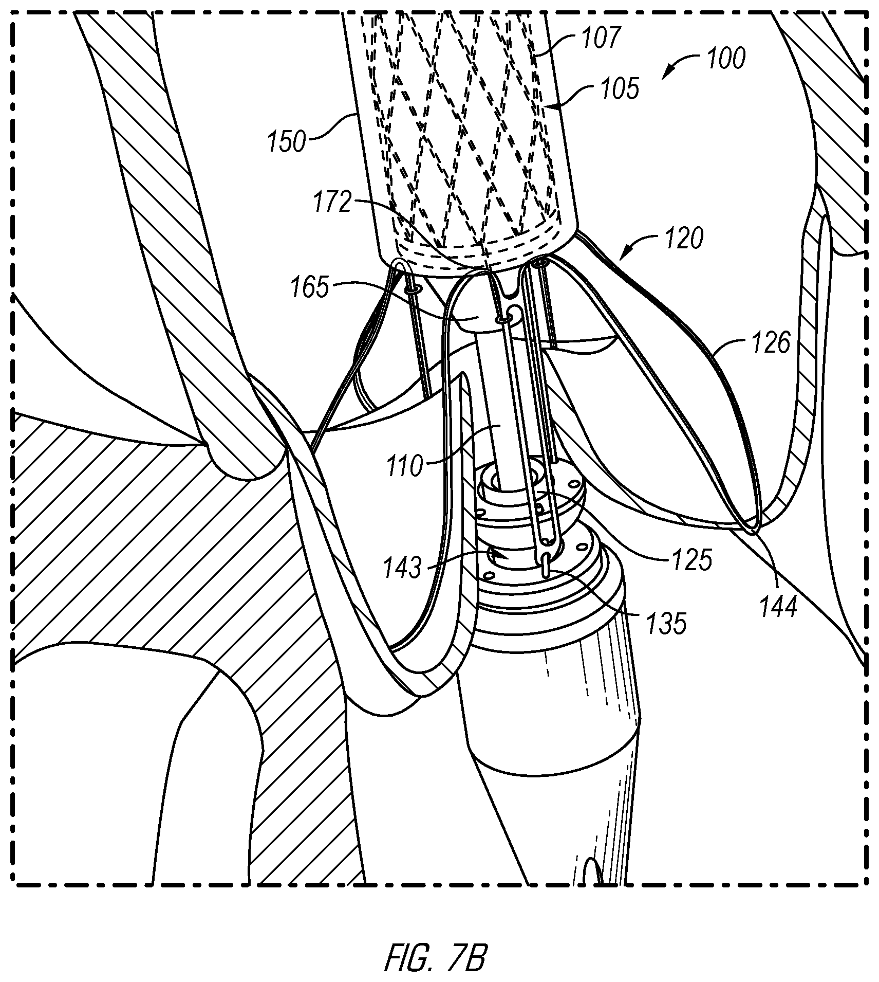 Patent US12376962 Figure 10 – Methods and devices for delivery of a prosthetic valve