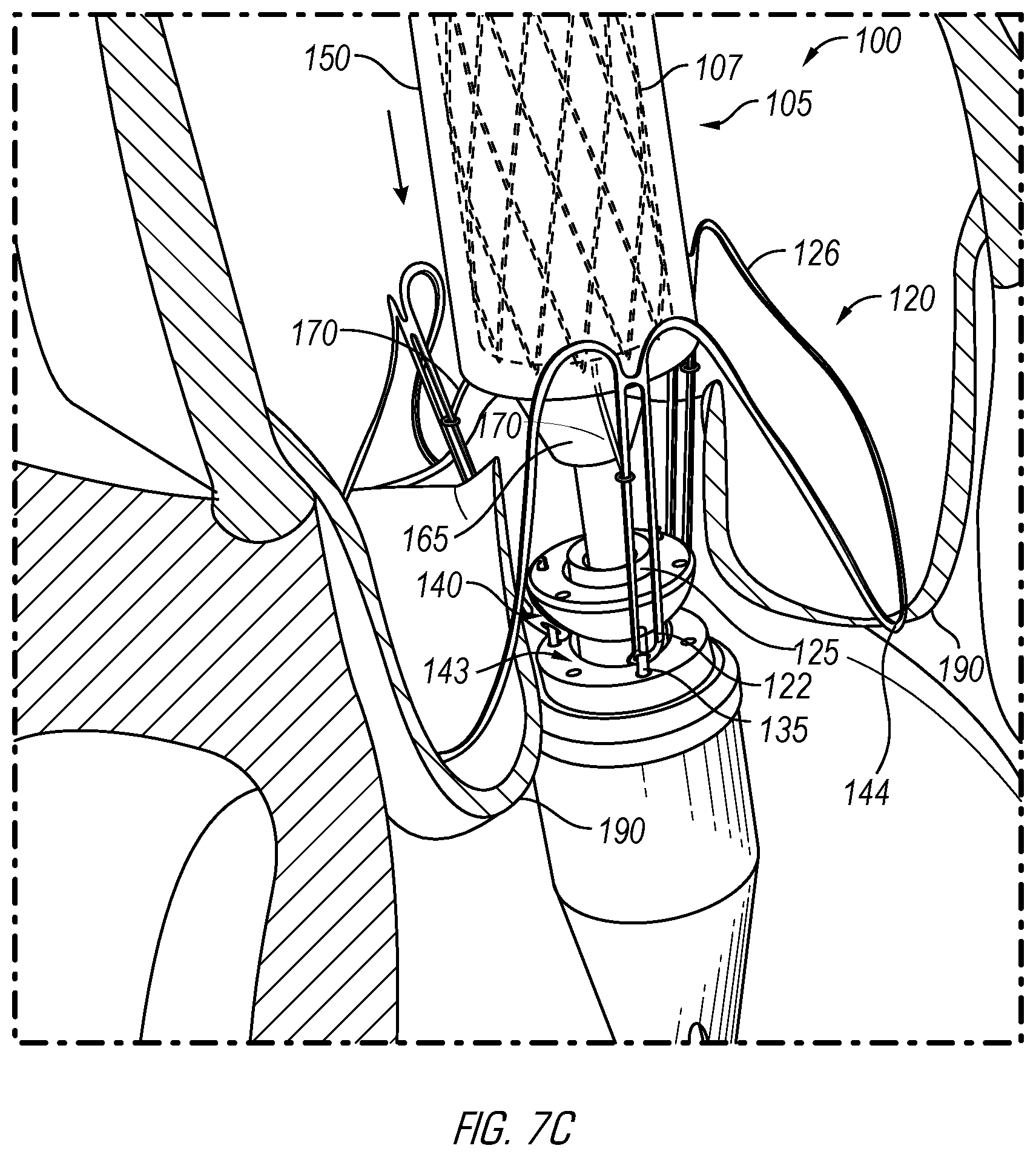 Patent US12376962 Figure 11 – Methods and devices for delivery of a prosthetic valve