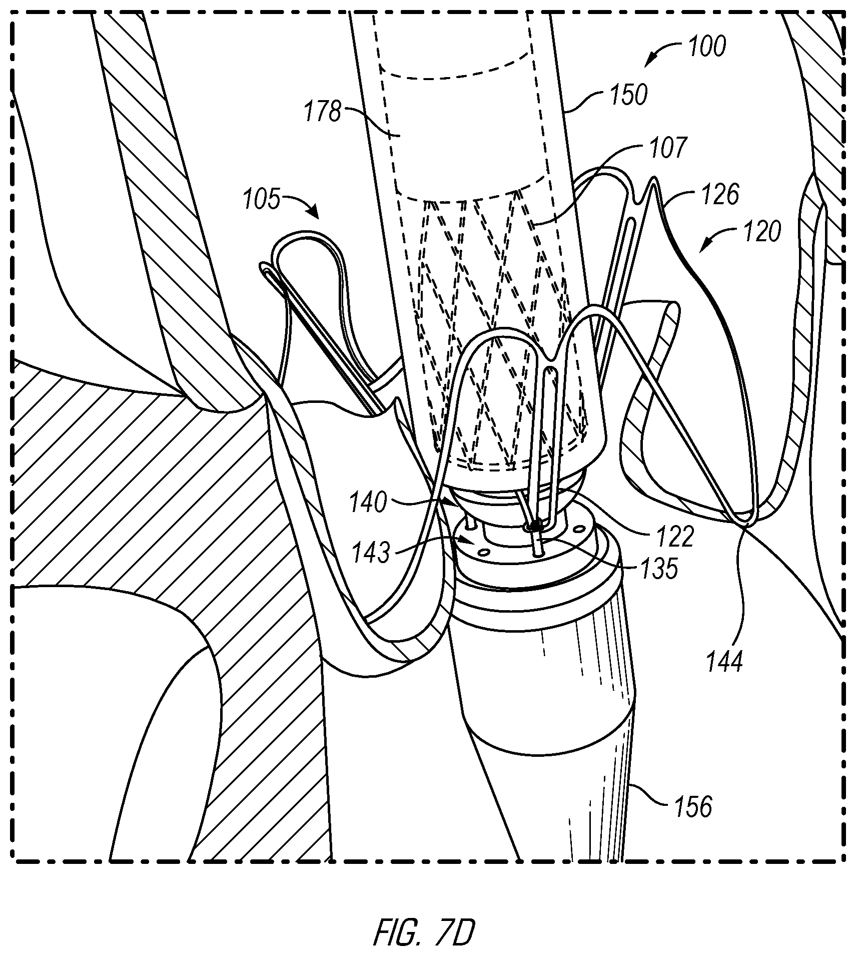 Patent US12376962 Figure 12 – Methods and devices for delivery of a prosthetic valve