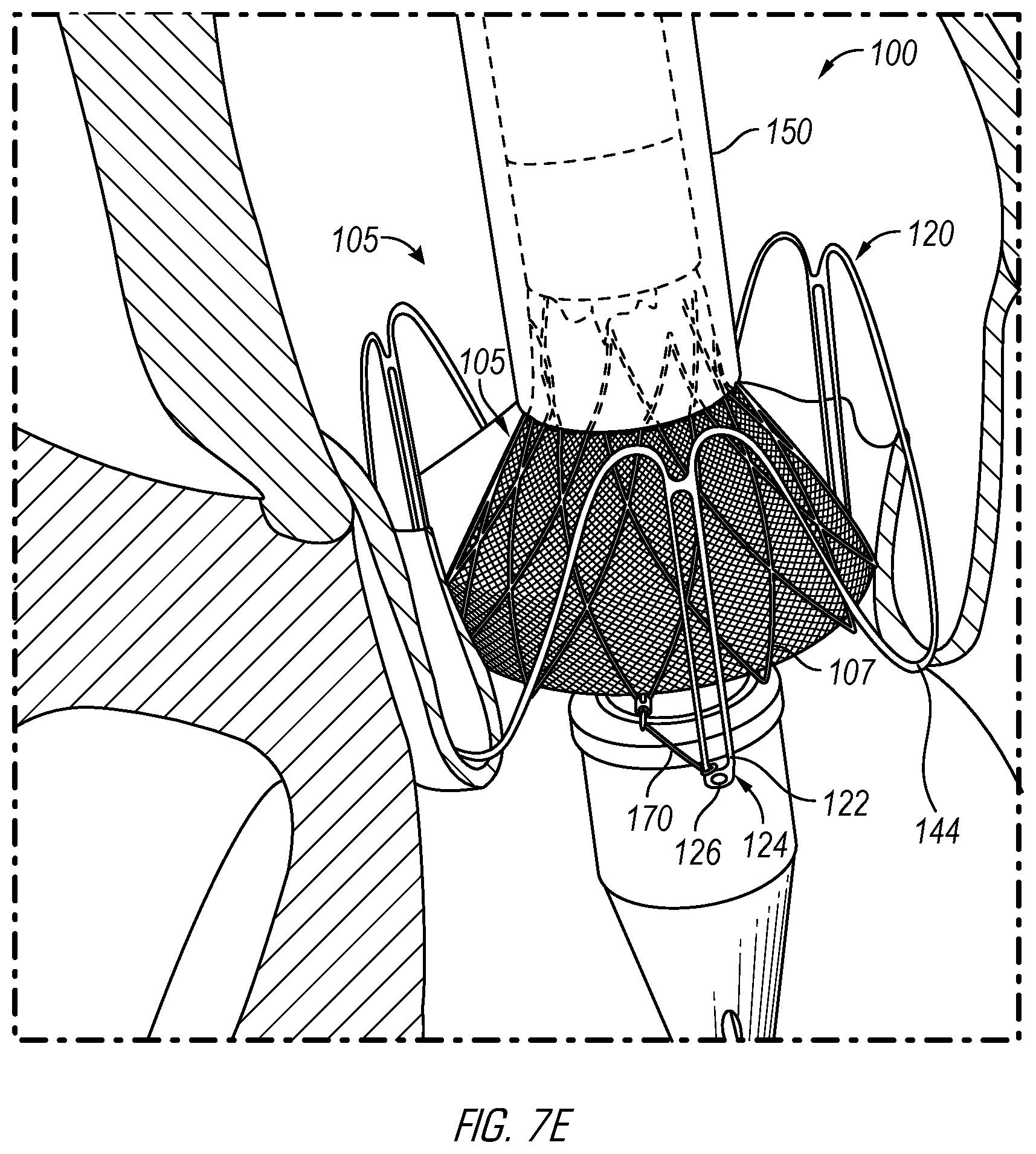 Patent US12376962 Figure 13 – Methods and devices for delivery of a prosthetic valve