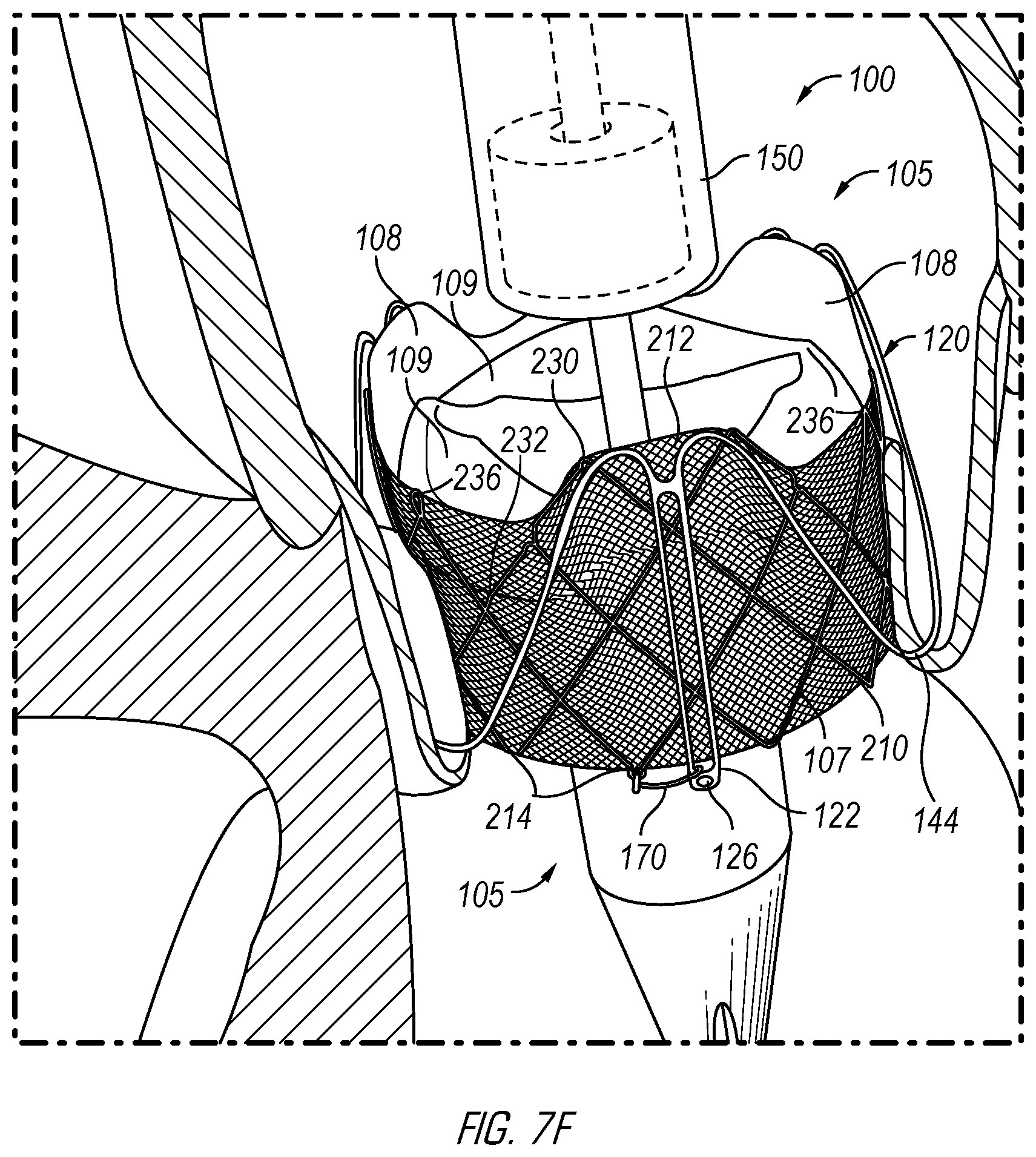 Patent US12376962 Figure 14 – Methods and devices for delivery of a prosthetic valve