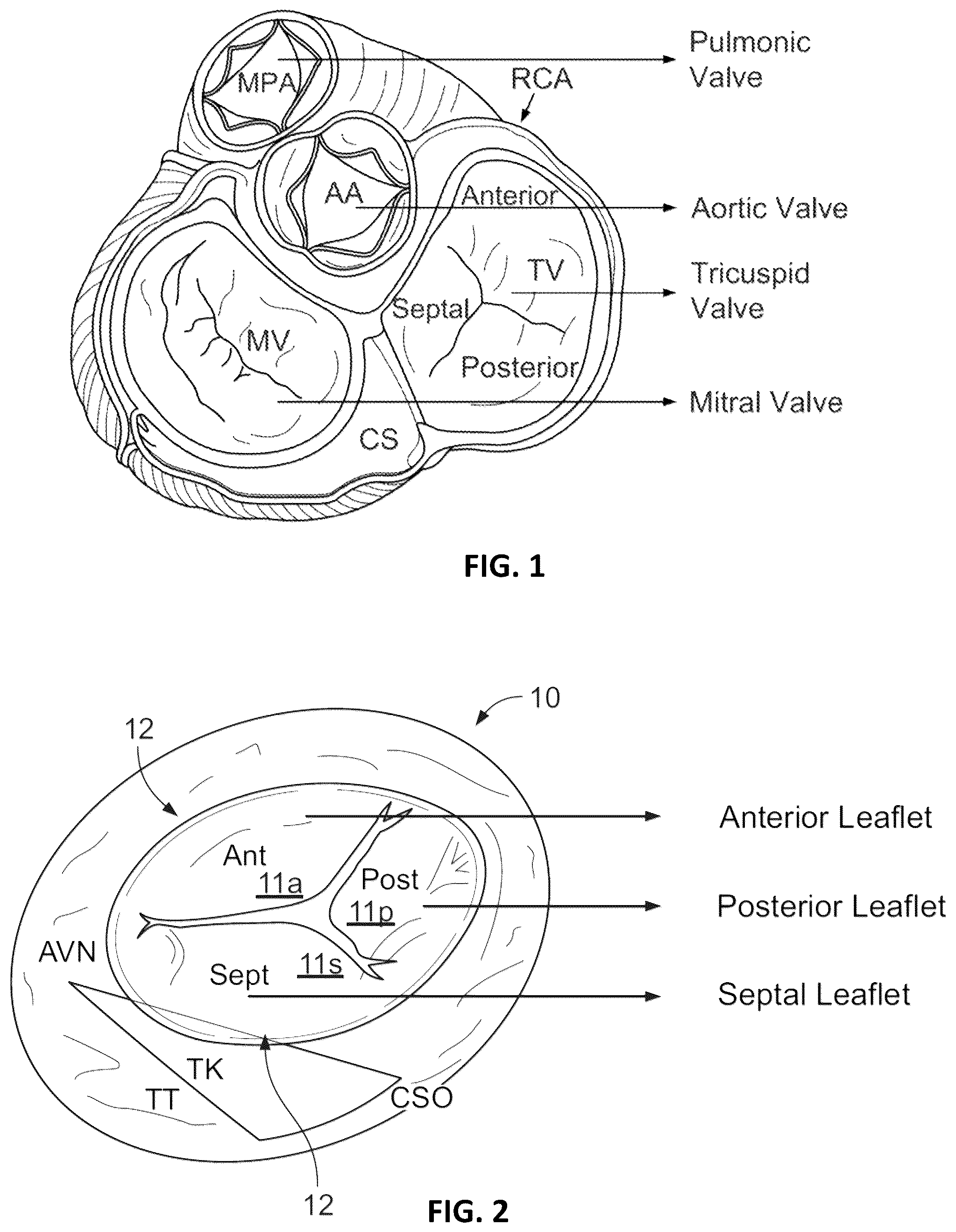 Patent US12376963 — Prosthetic heart valves — Figure 1