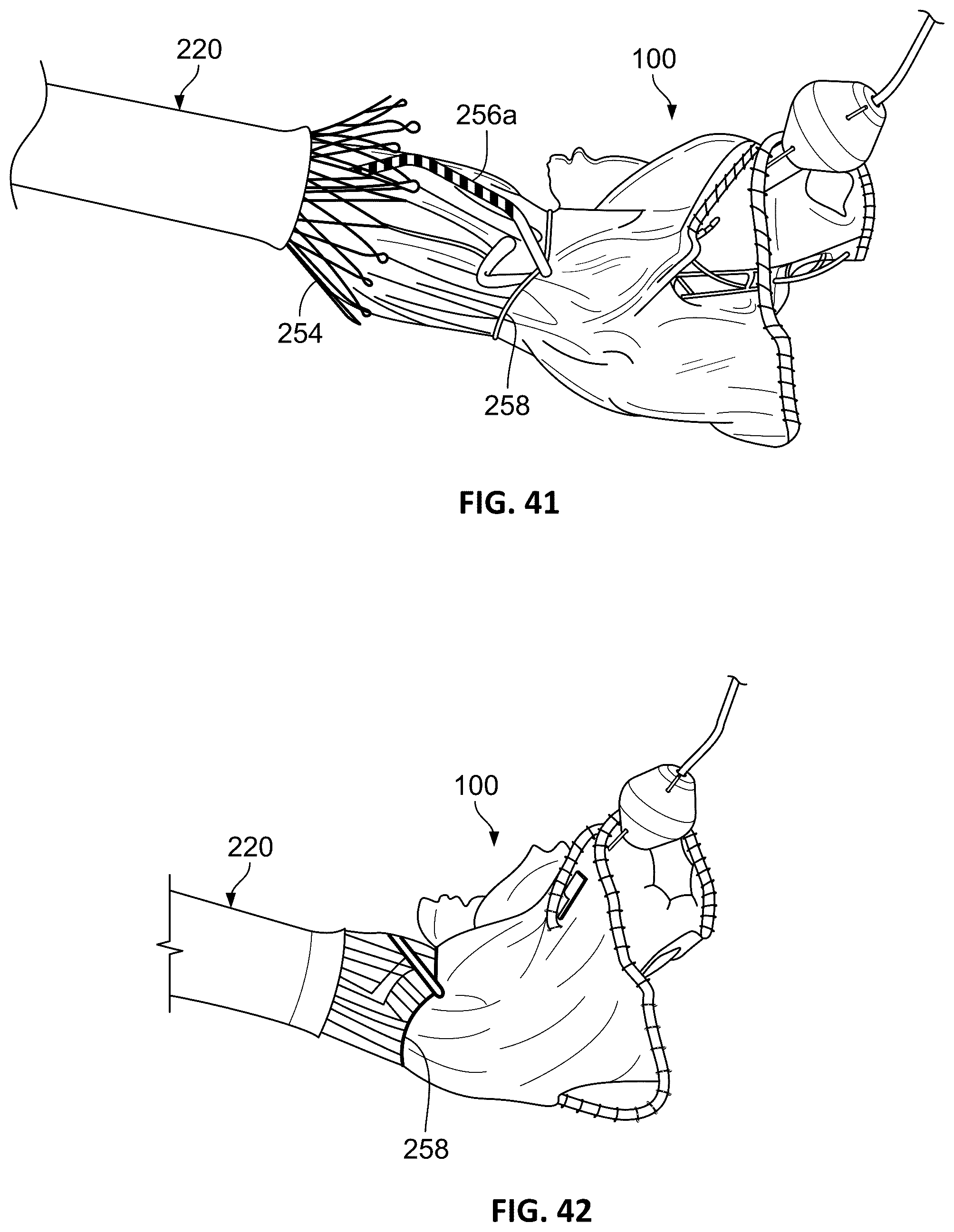 Patent US12376963 Figure 20 – Prosthetic heart valves