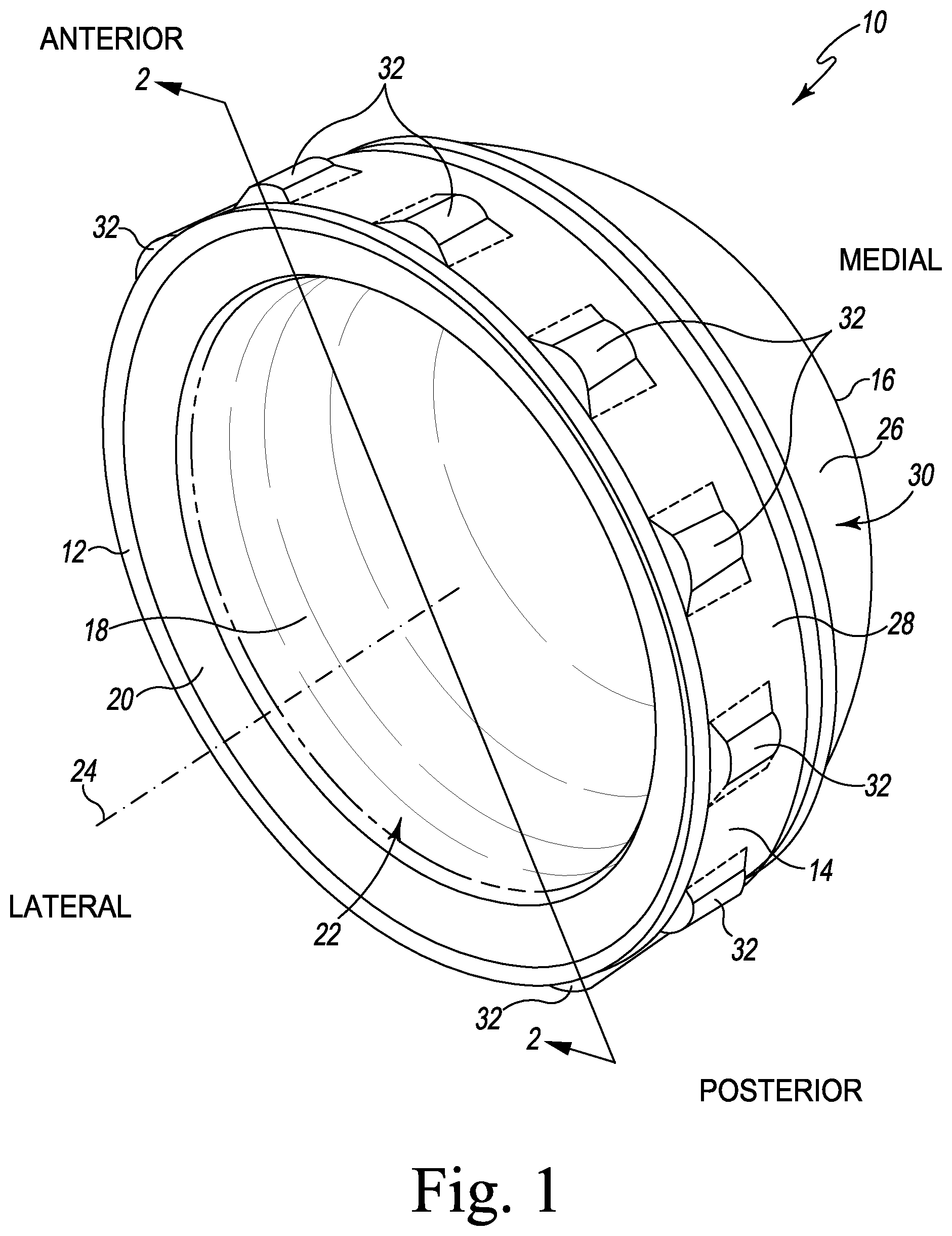 Patent US12376964 Figure 1 – Apparatus and method for locking an acetabular liner to an acetabular cup