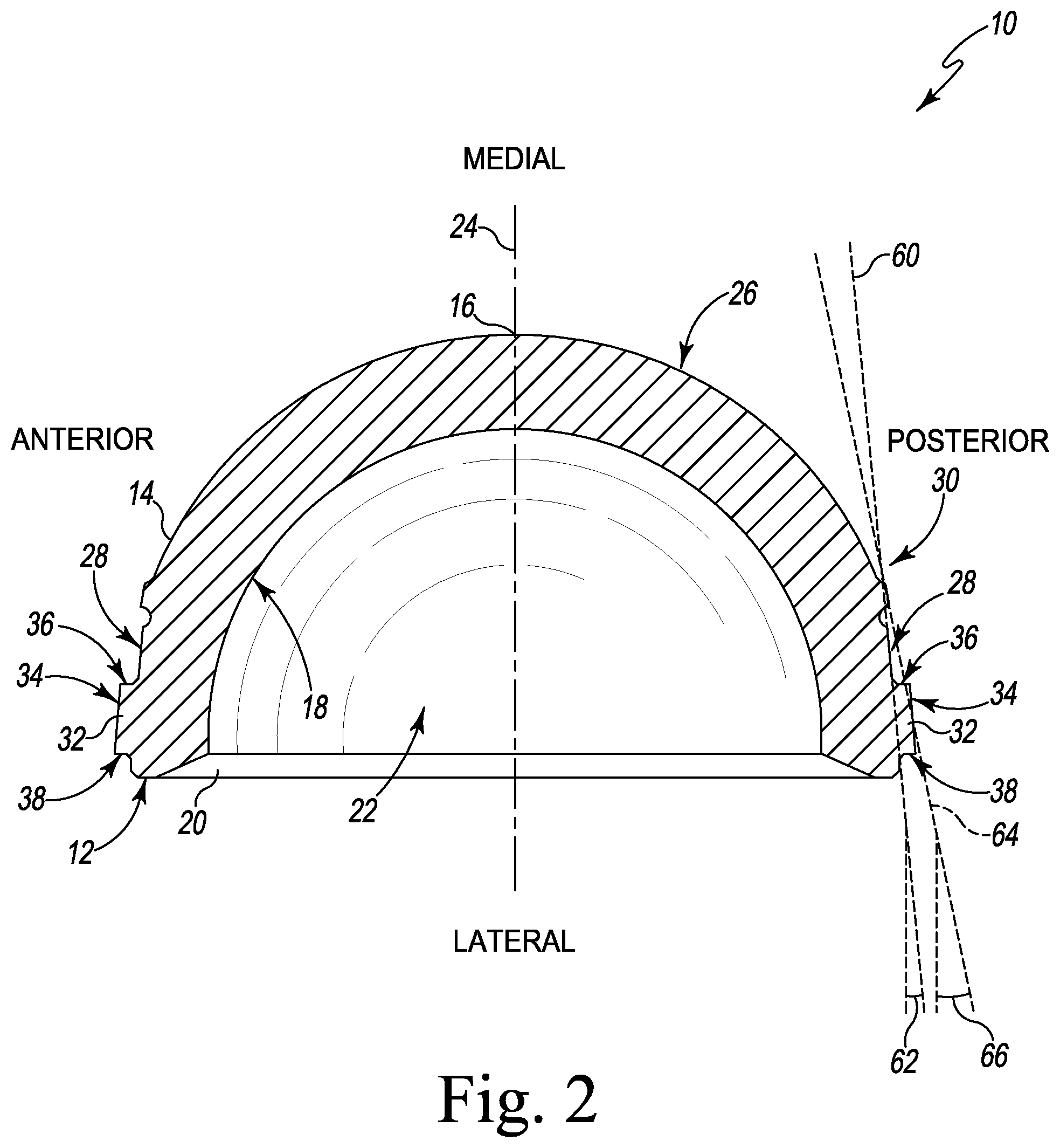 Patent US12376964 Figure 2 – Apparatus and method for locking an acetabular liner to an acetabular cup