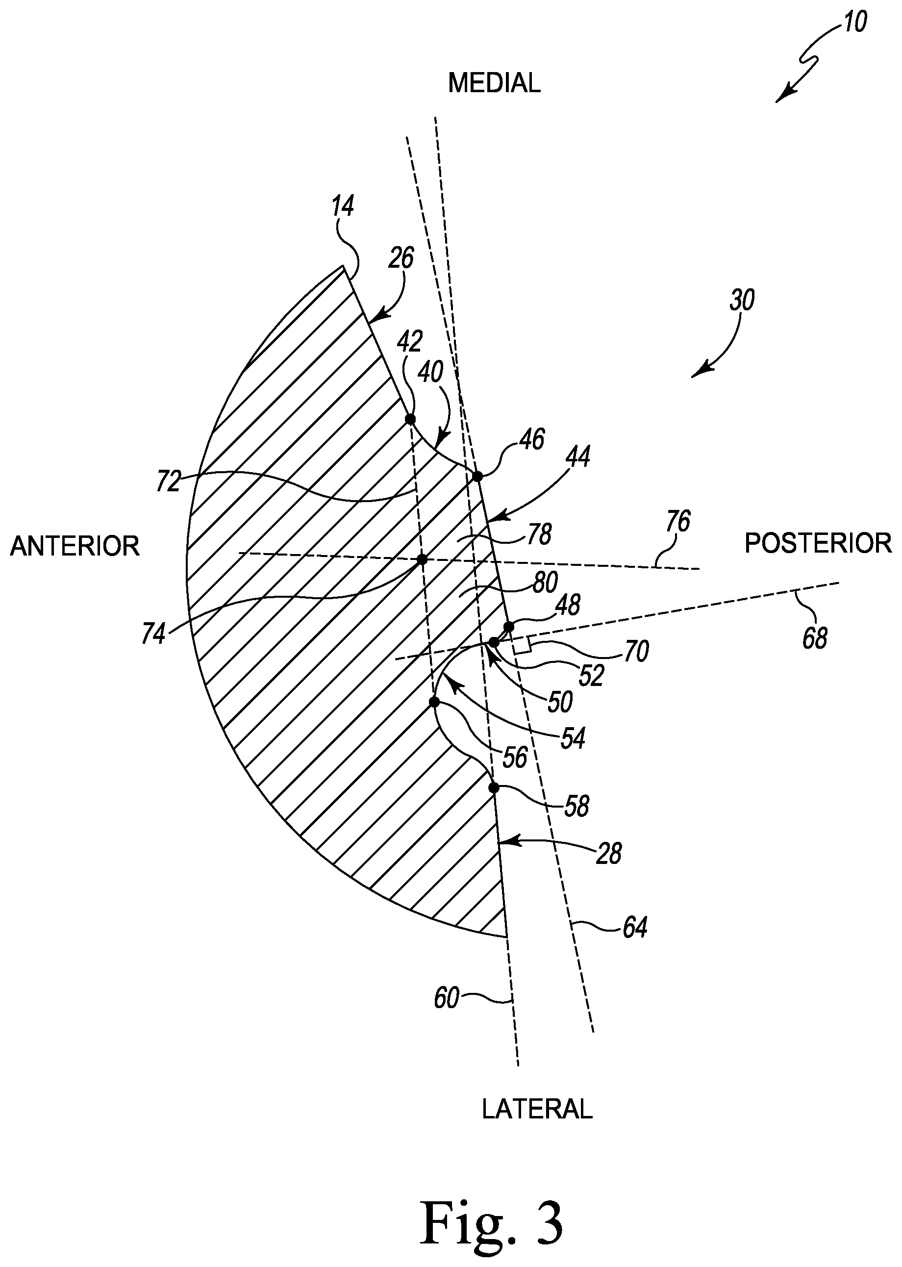 Patent US12376964 Figure 3 – Apparatus and method for locking an acetabular liner to an acetabular cup