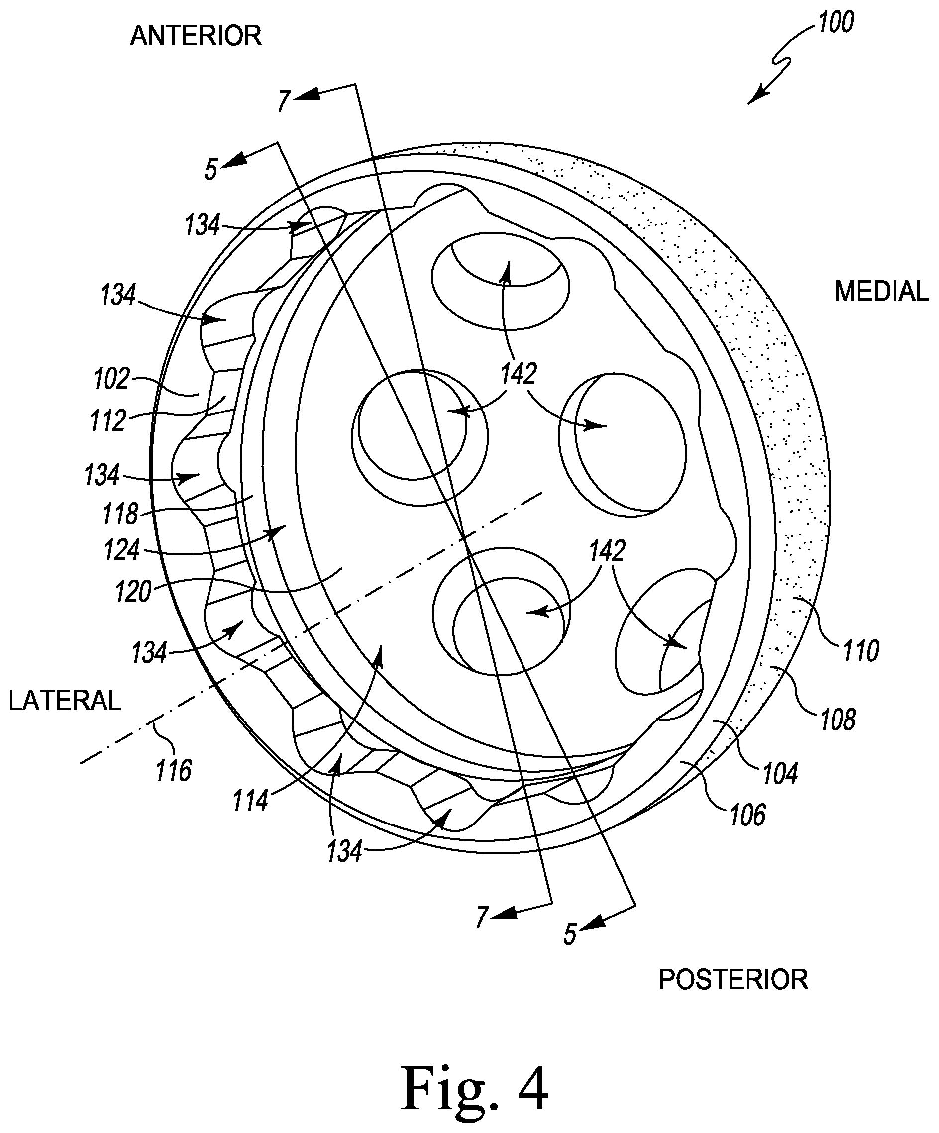 Patent US12376964 Figure 4 – Apparatus and method for locking an acetabular liner to an acetabular cup