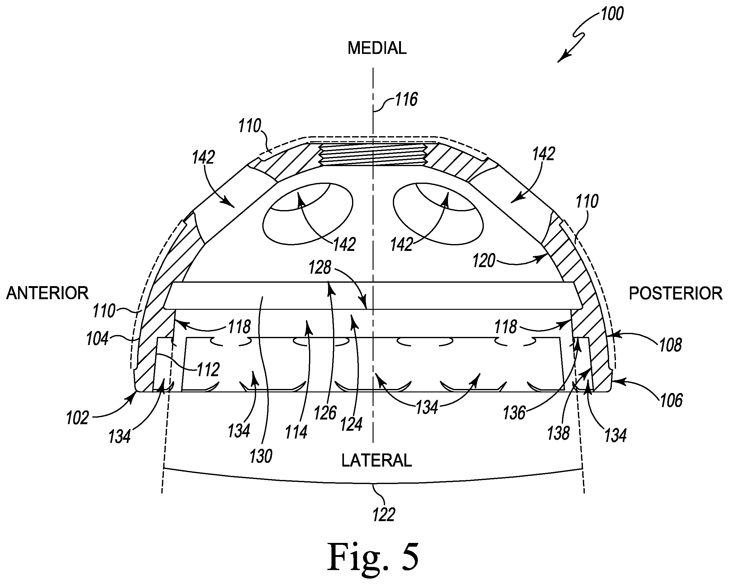 Patent US12376964 Figure 5 – Apparatus and method for locking an acetabular liner to an acetabular cup