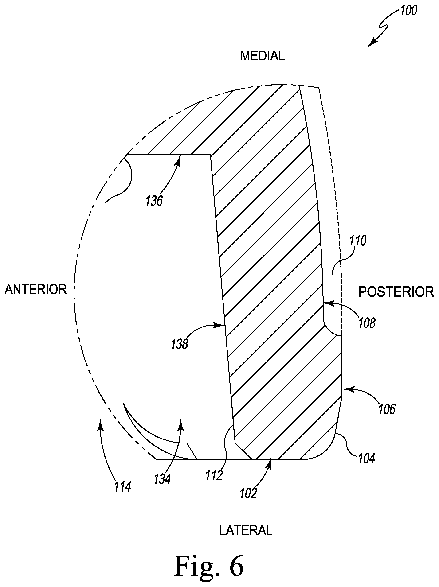 Patent US12376964 Figure 6 – Apparatus and method for locking an acetabular liner to an acetabular cup