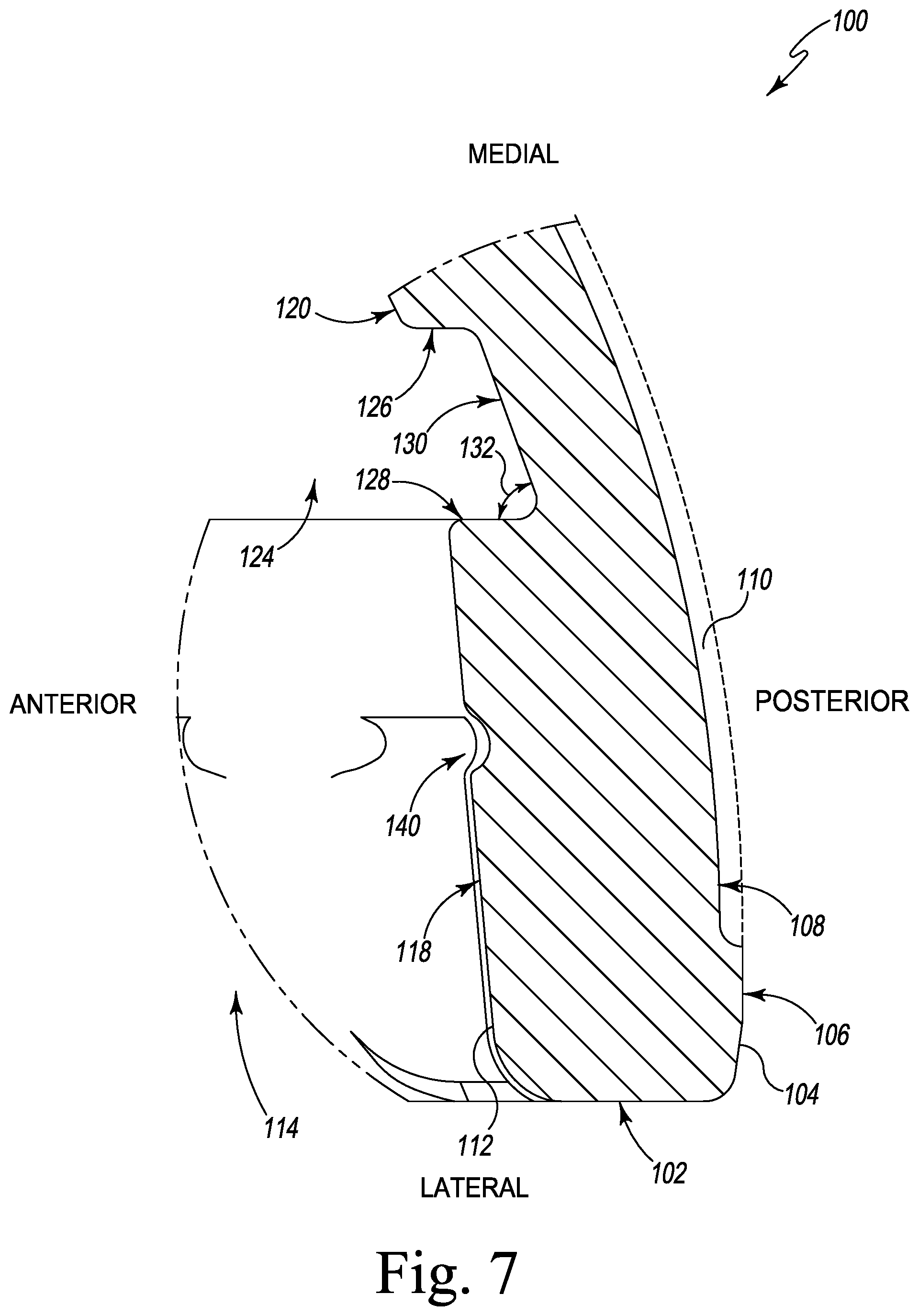 Patent US12376964 Figure 7 – Apparatus and method for locking an acetabular liner to an acetabular cup