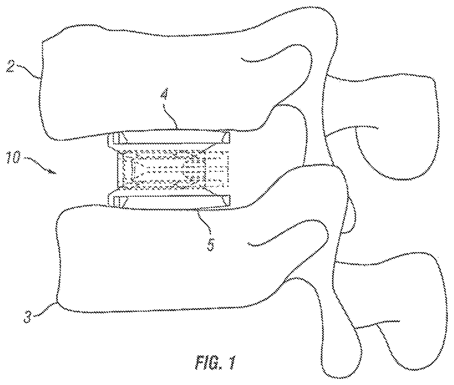 Patent US12376967 Figure 1 – Expandable fusion device and method of installation thereof