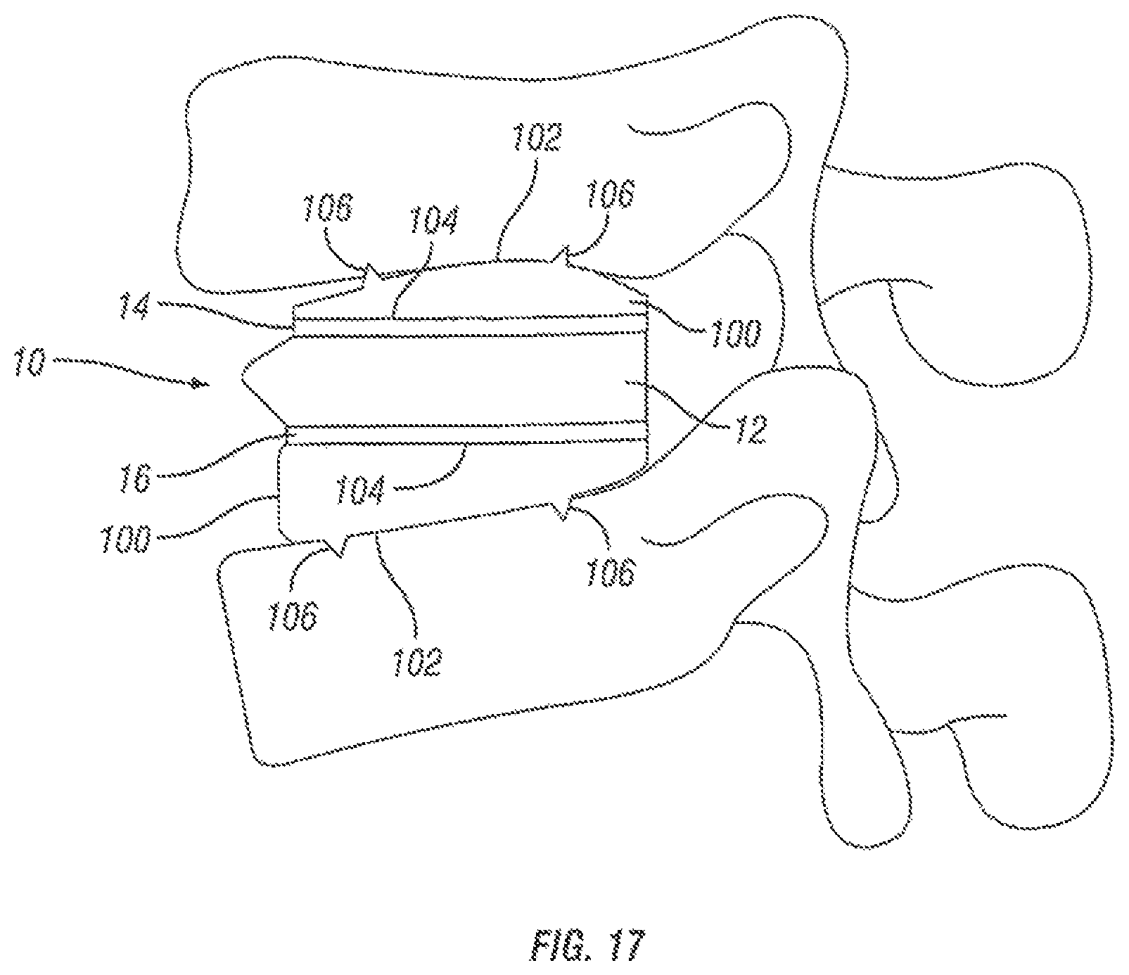 Patent US12376967 Figure 9 – Expandable fusion device and method of installation thereof