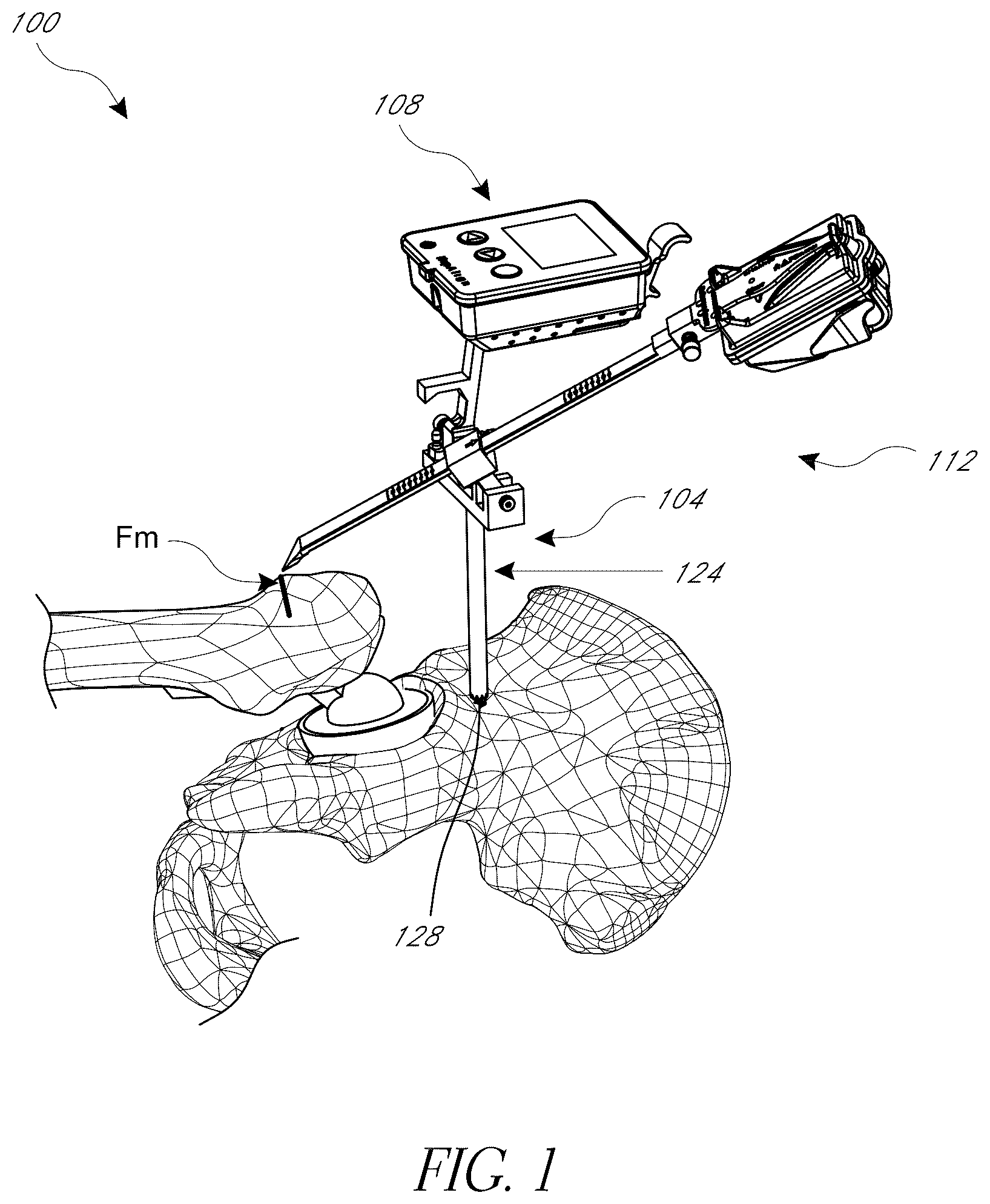 Patent US12376972 Figure 1 – Hip replacement navigation system and method