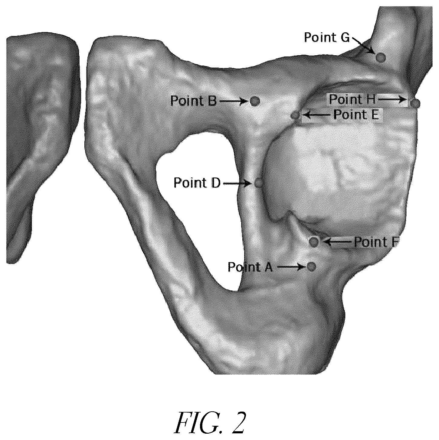 Patent US12376972 Figure 2 – Hip replacement navigation system and method