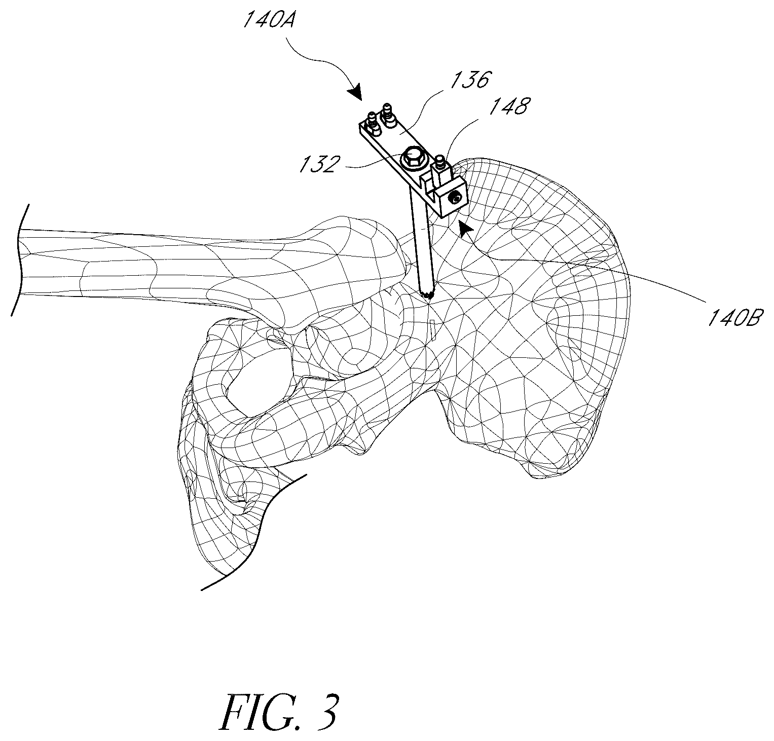 Patent US12376972 Figure 3 – Hip replacement navigation system and method