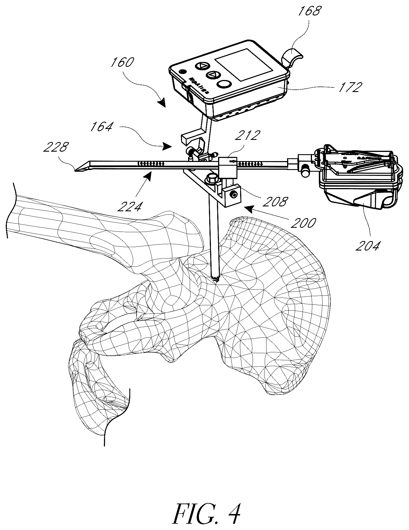 Patent US12376972 Figure 4 – Hip replacement navigation system and method