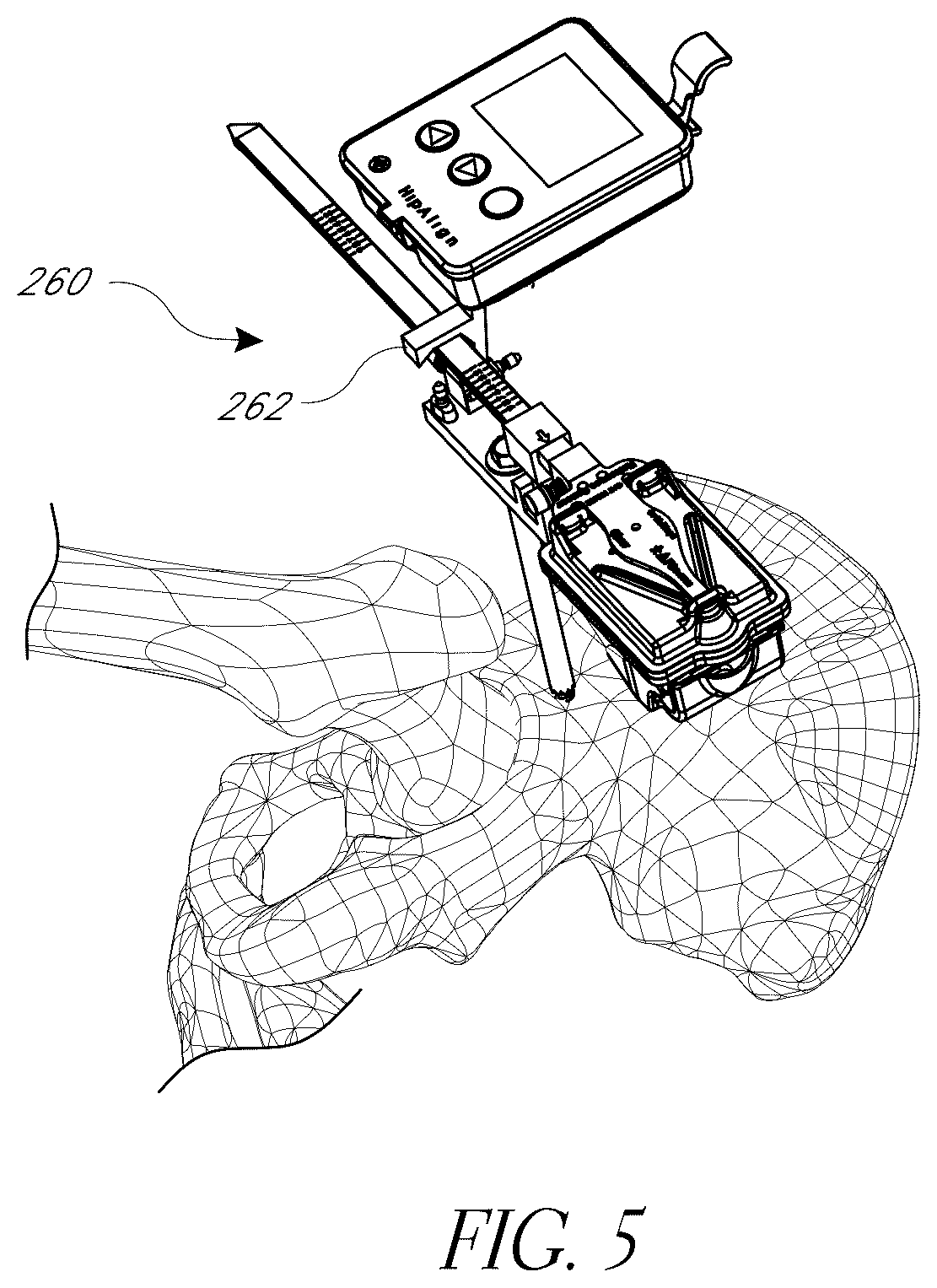 Patent US12376972 Figure 5 – Hip replacement navigation system and method
