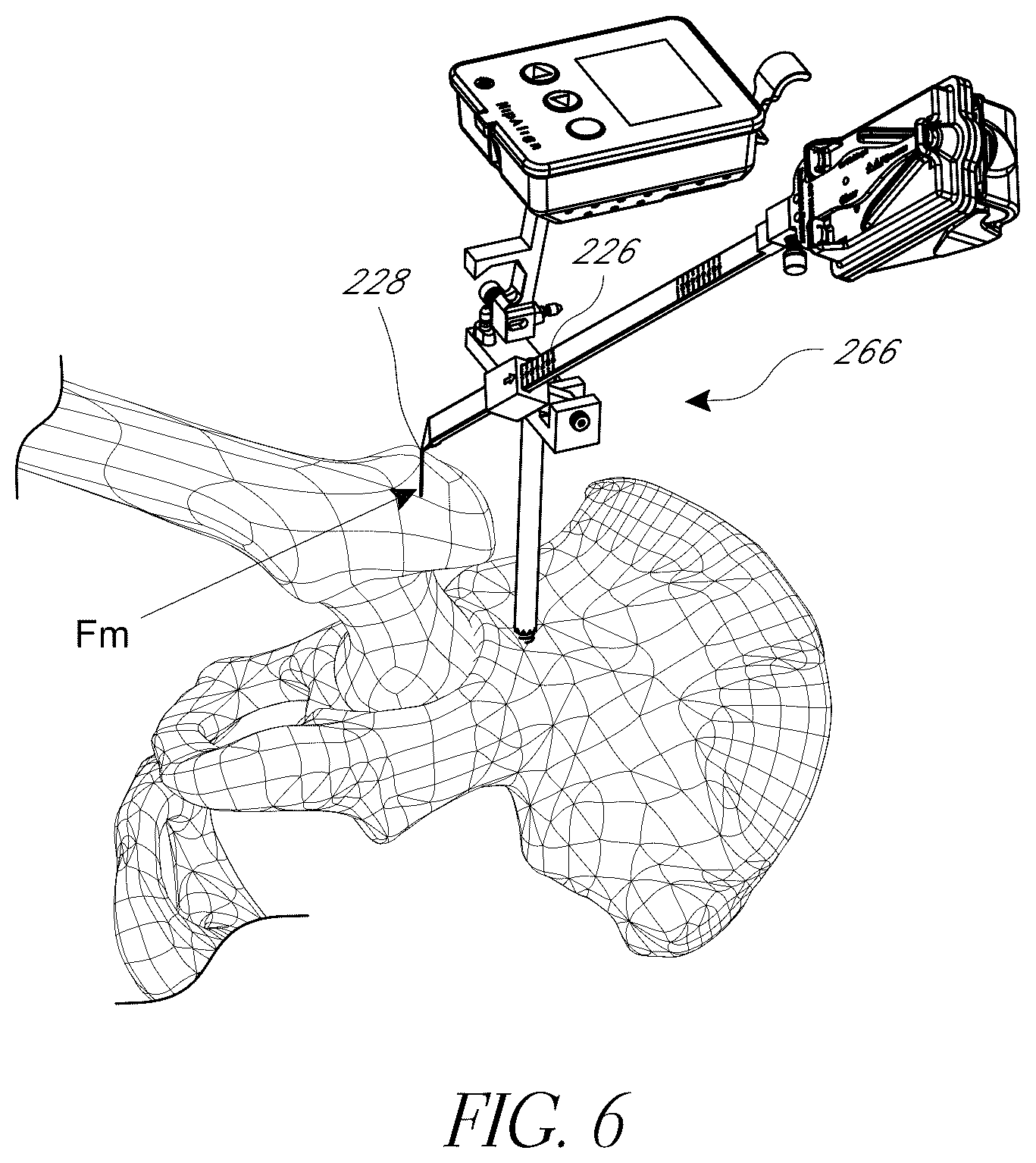 Patent US12376972 Figure 6 – Hip replacement navigation system and method