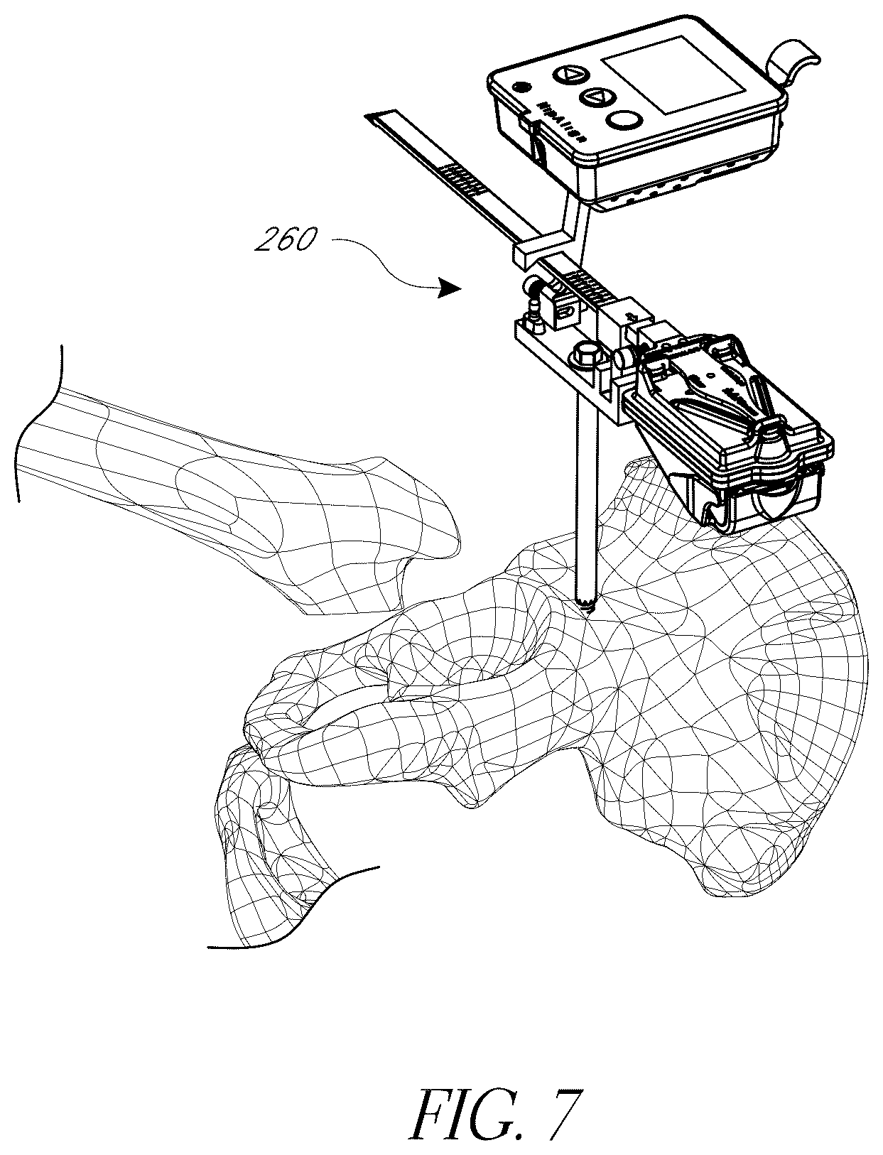Patent US12376972 Figure 7 – Hip replacement navigation system and method