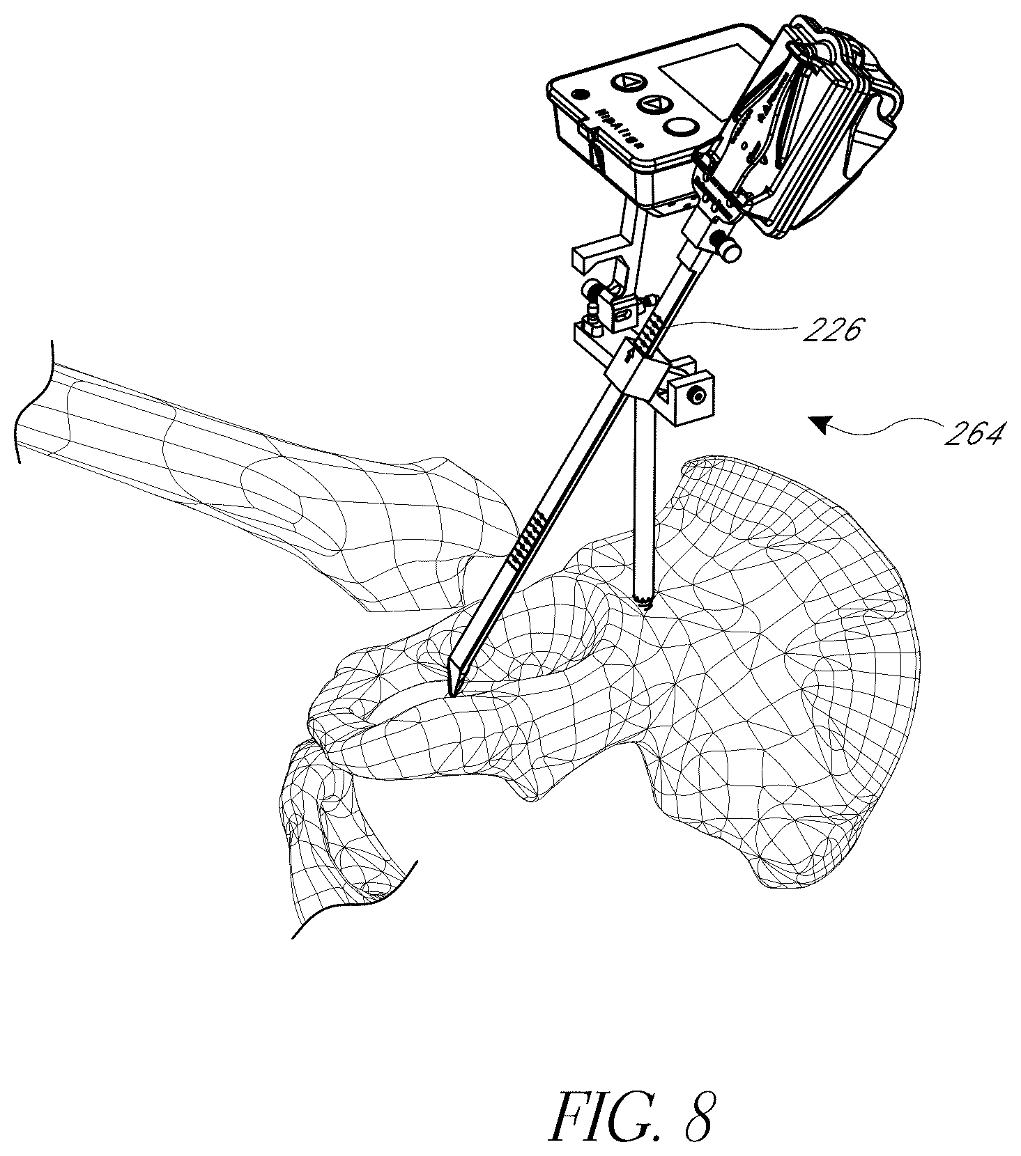Patent US12376972 Figure 8 – Hip replacement navigation system and method