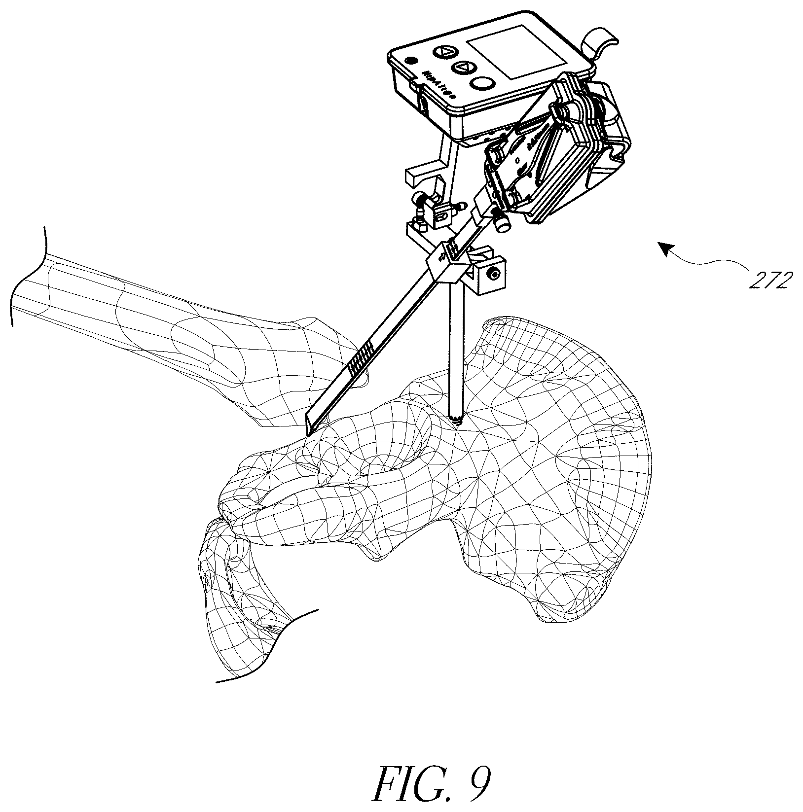 Patent US12376972 Figure 9 – Hip replacement navigation system and method