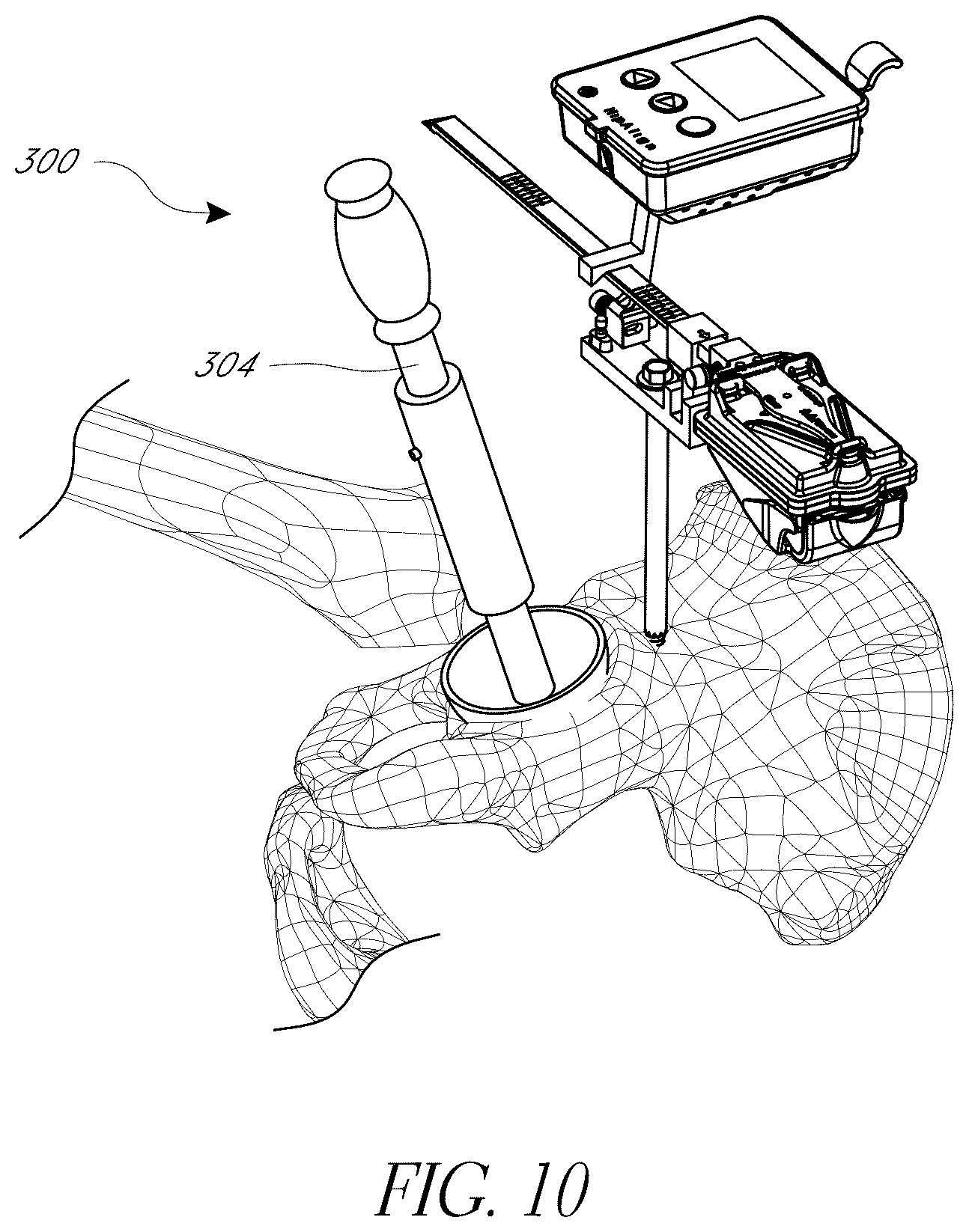 Patent US12376972 Figure 10 – Hip replacement navigation system and method
