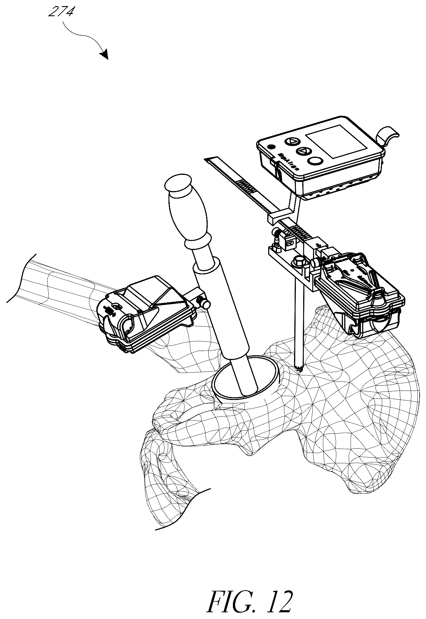 Patent US12376972 Figure 15 – Hip replacement navigation system and method