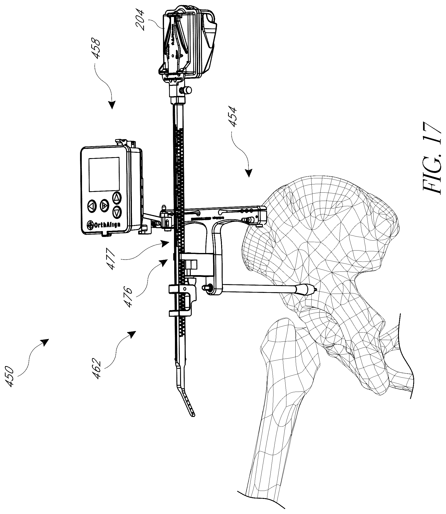 Patent US12376972 Figure 20 – Hip replacement navigation system and method