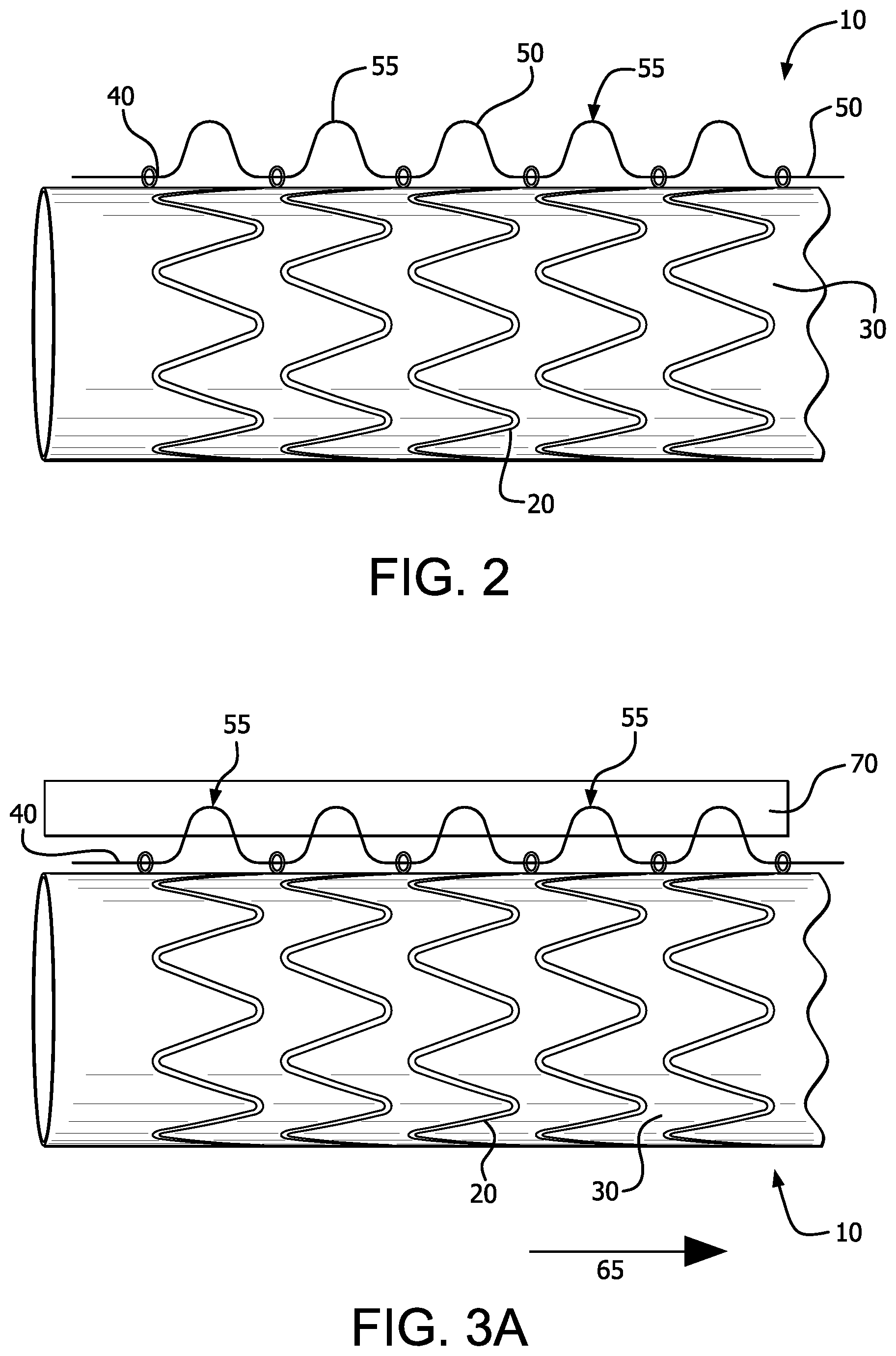 Patent US12376977 Figure 2 – Stent graft device with anchoring members having adjustable geometries
