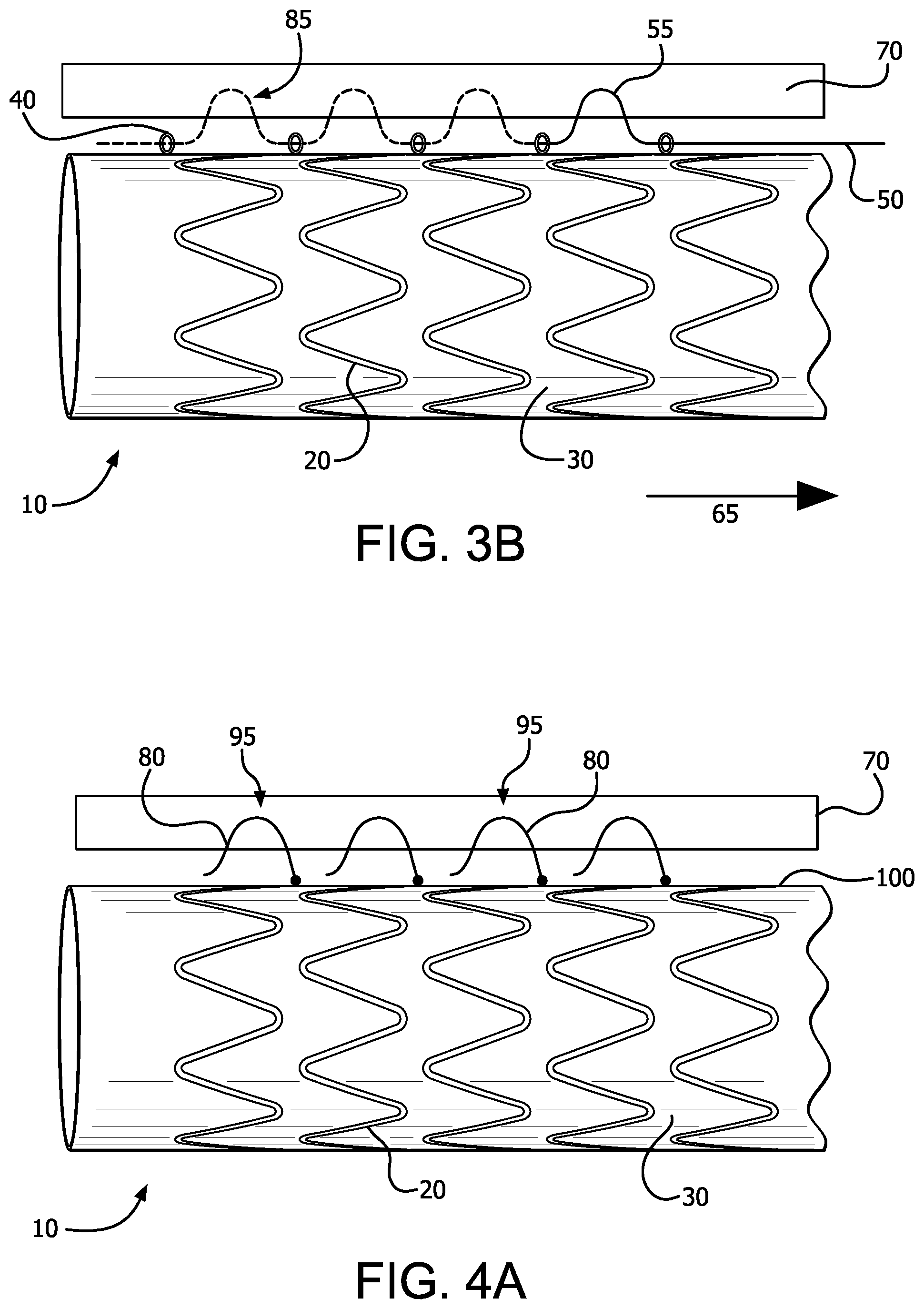 Patent US12376977 Figure 3 – Stent graft device with anchoring members having adjustable geometries