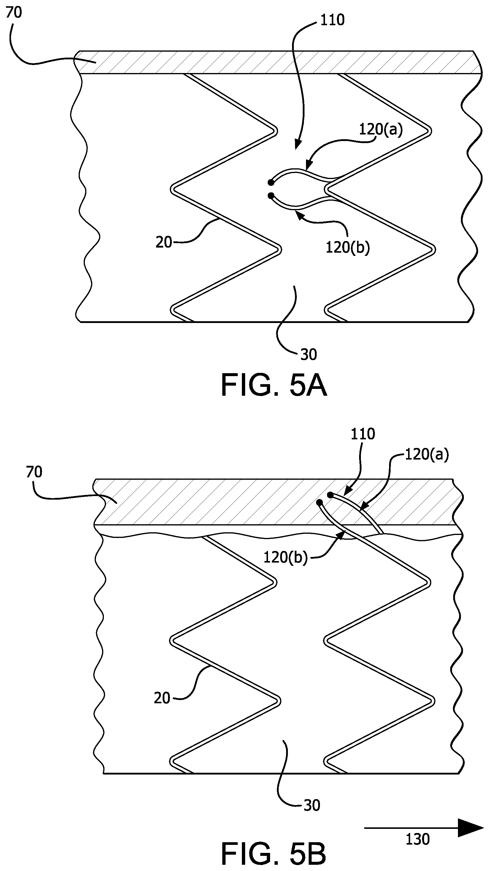 Patent US12376977 Figure 5 – Stent graft device with anchoring members having adjustable geometries