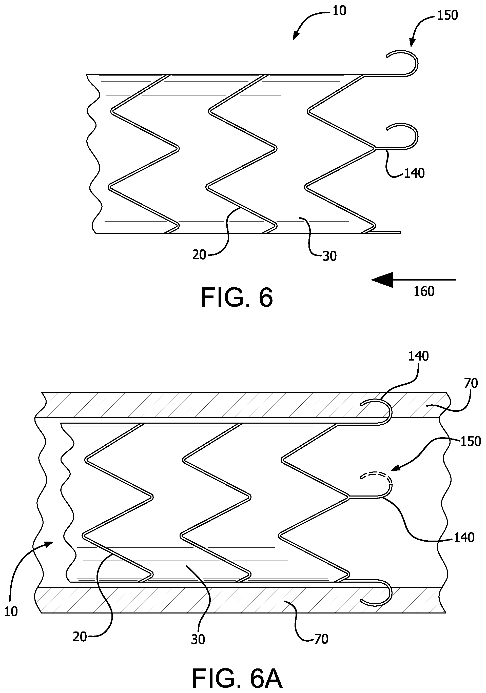 Patent US12376977 Figure 7 – Stent graft device with anchoring members having adjustable geometries
