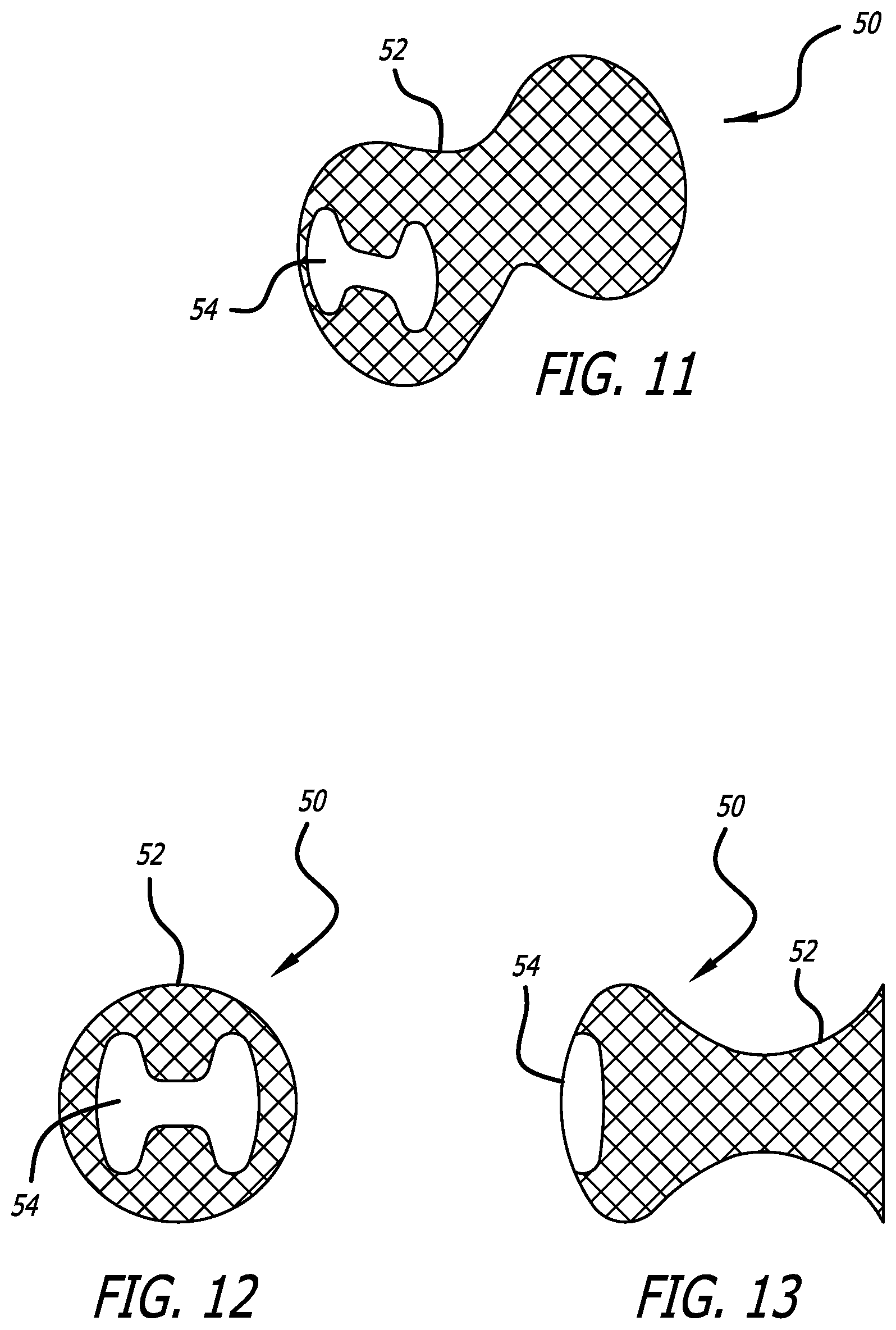 Patent US12376978 Figure 4 – Methods and technology for creating connections and shunts between vessels and chambers of biologic structures