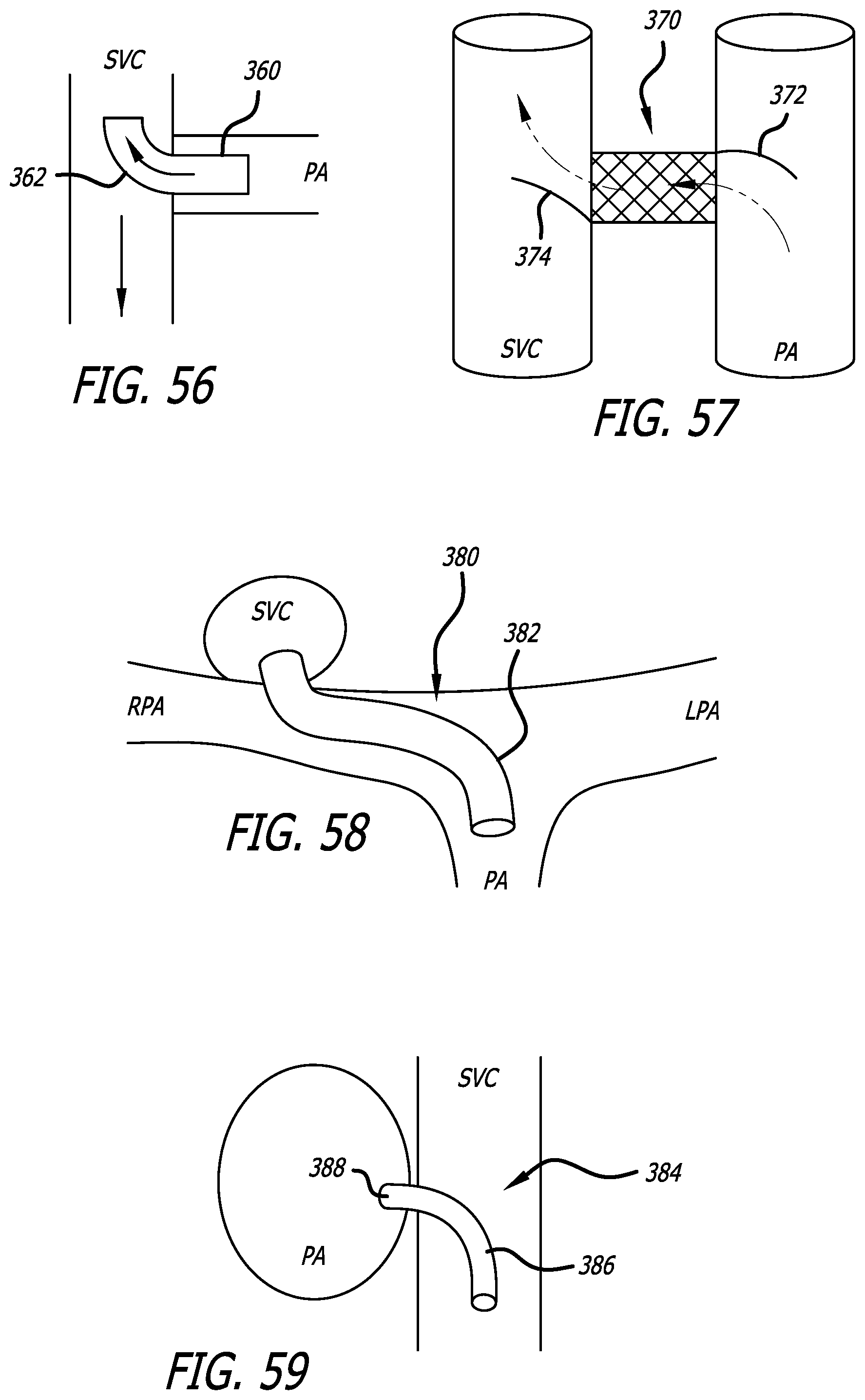 Patent US12376978 Figure 17 – Methods and technology for creating connections and shunts between vessels and chambers of biologic structures