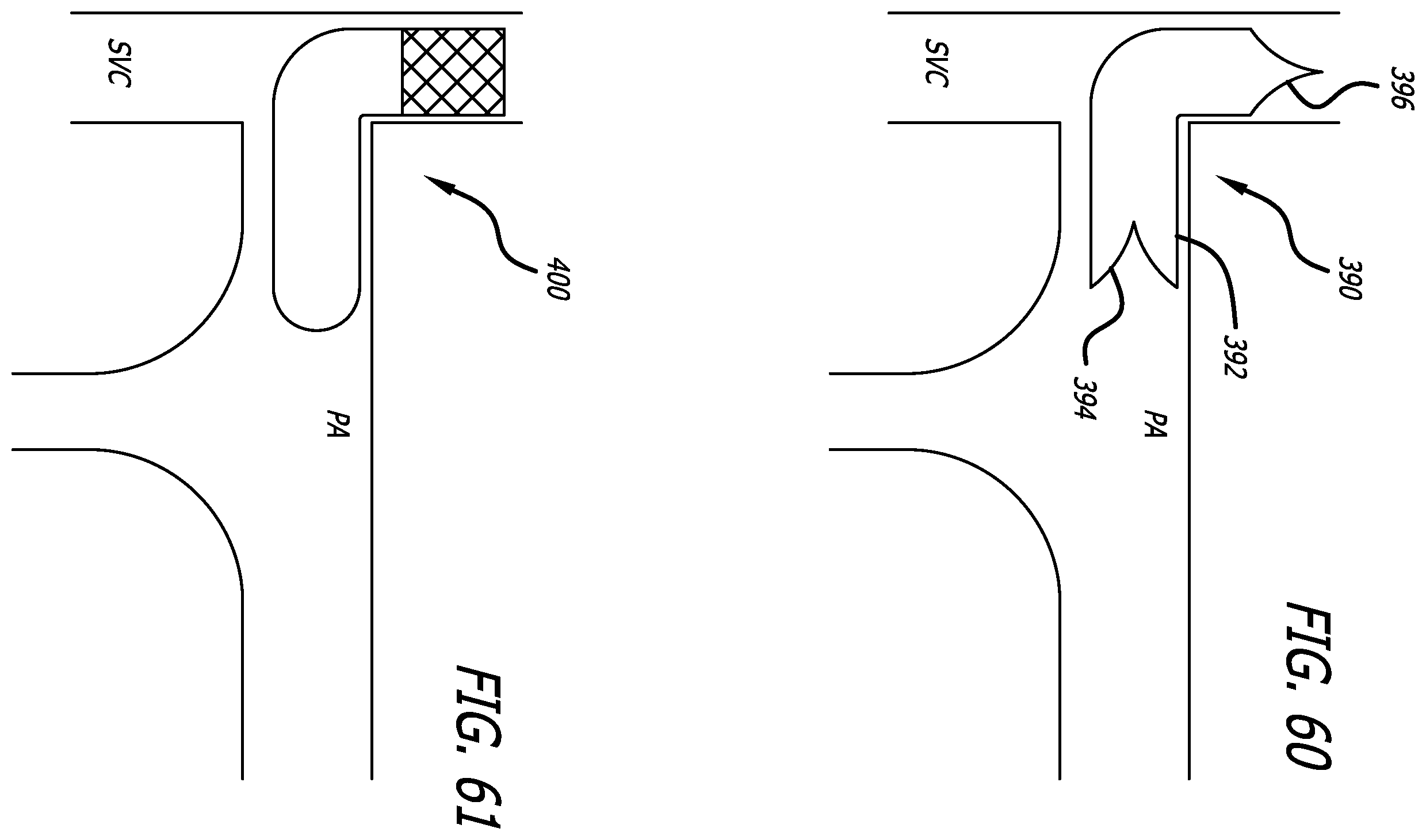 Patent US12376978 Figure 18 – Methods and technology for creating connections and shunts between vessels and chambers of biologic structures