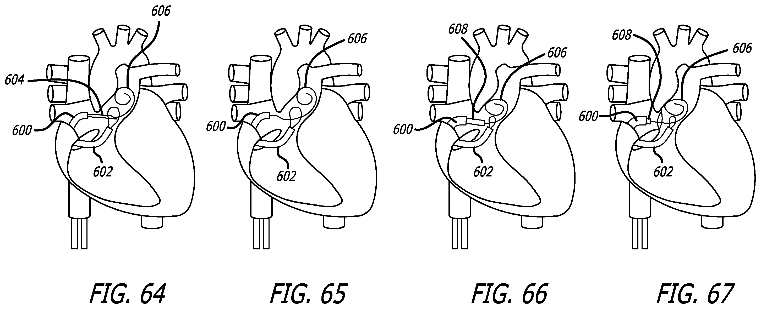 Patent US12376978 Figure 20 – Methods and technology for creating connections and shunts between vessels and chambers of biologic structures