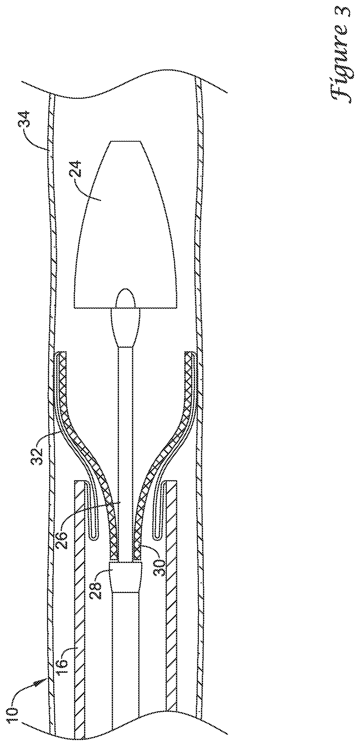 Patent US12376980 Figure 3 – Stent delivery systems with a reconstraining member