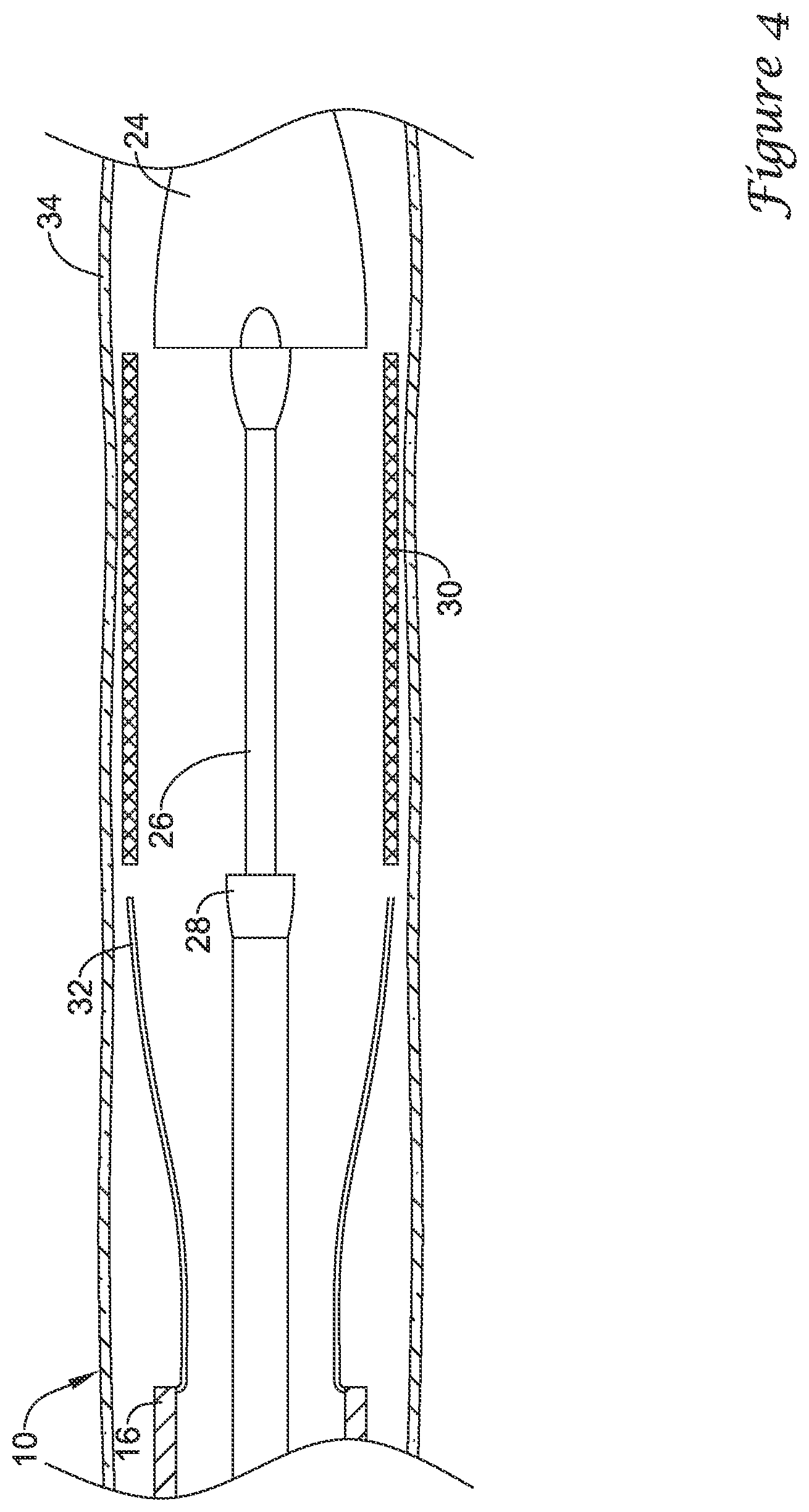 Patent US12376980 Figure 4 – Stent delivery systems with a reconstraining member