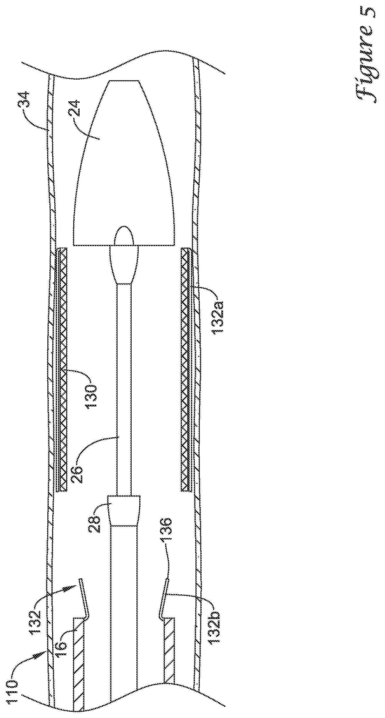 Patent US12376980 Figure 5 – Stent delivery systems with a reconstraining member